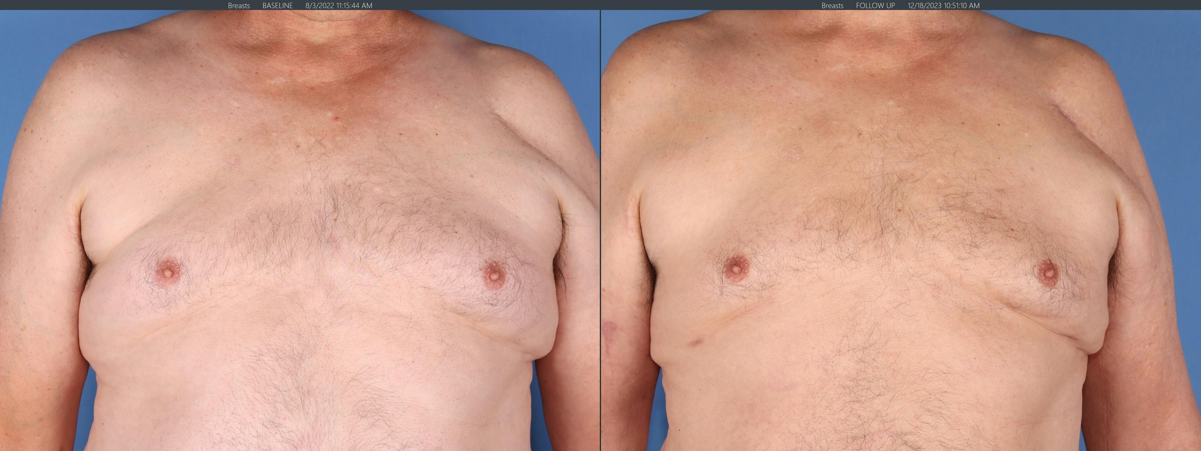 Chest Before & After Gallery - Patient 108530 - Image 1