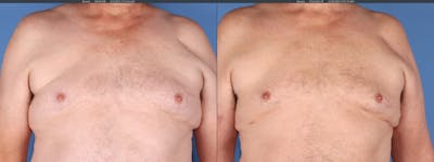 Chest Before & After Gallery - Patient 108530 - Image 1