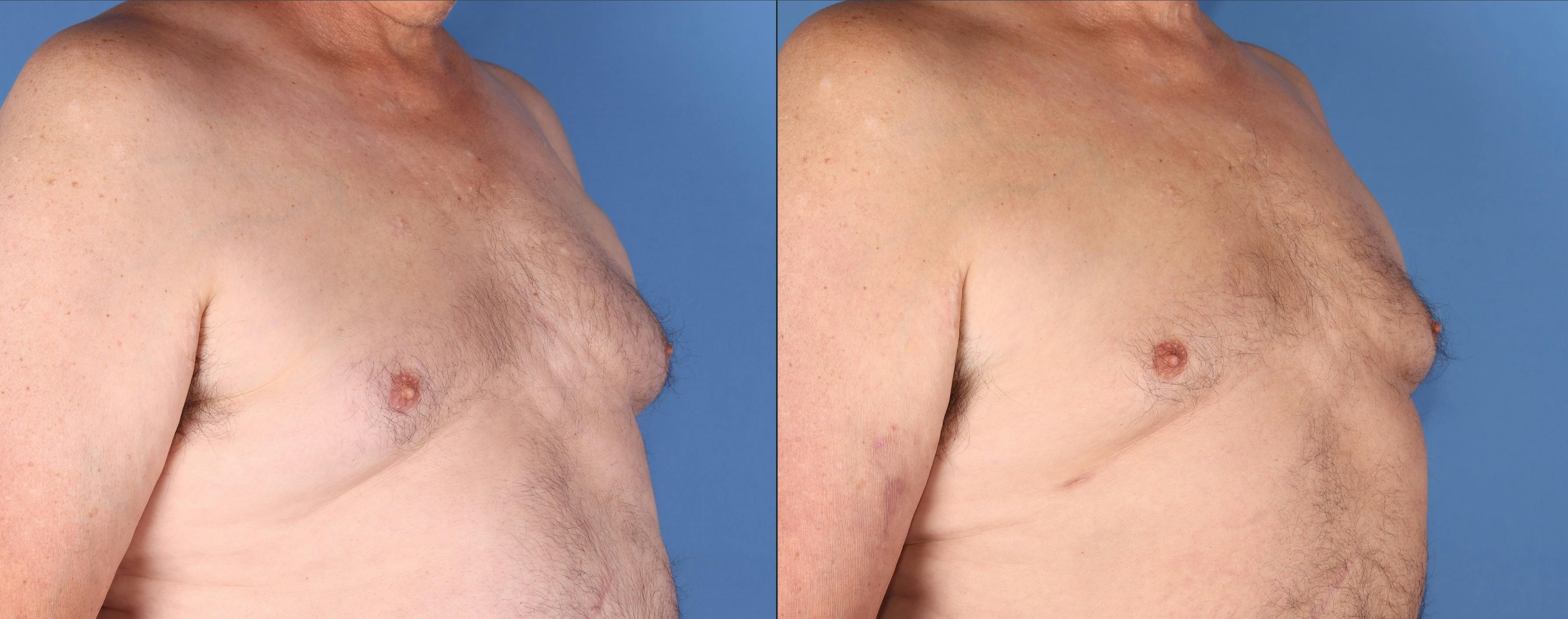 Chest Before & After Gallery - Patient 108530 - Image 2