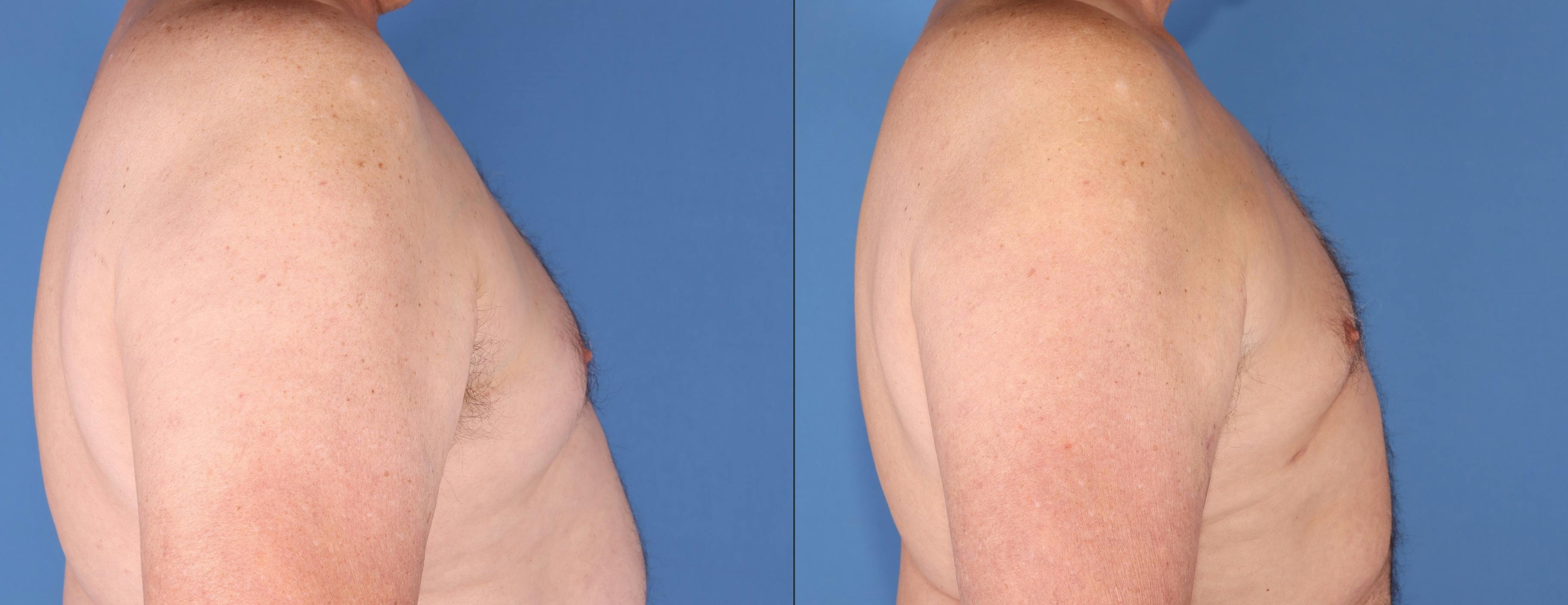Chest Before & After Gallery - Patient 108530 - Image 3