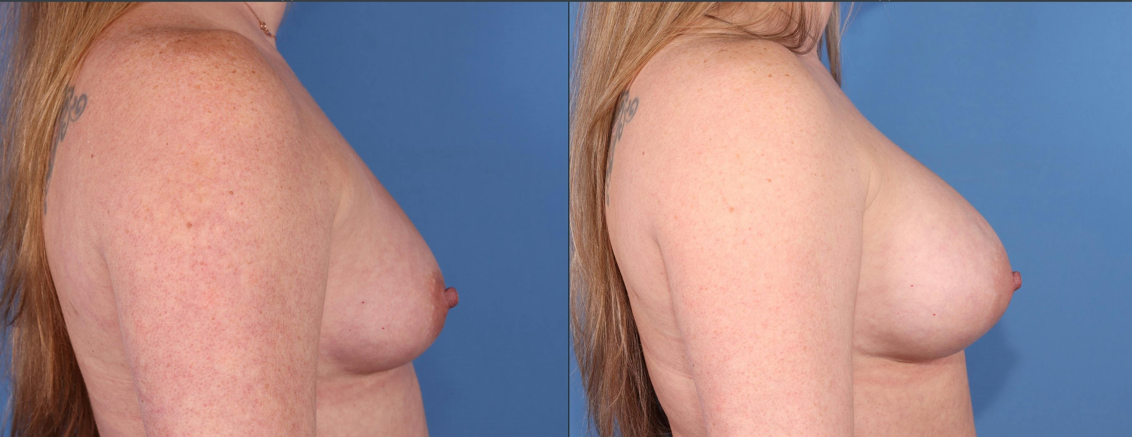 Breast Augmentation Before & After Gallery - Patient 252730 - Image 3