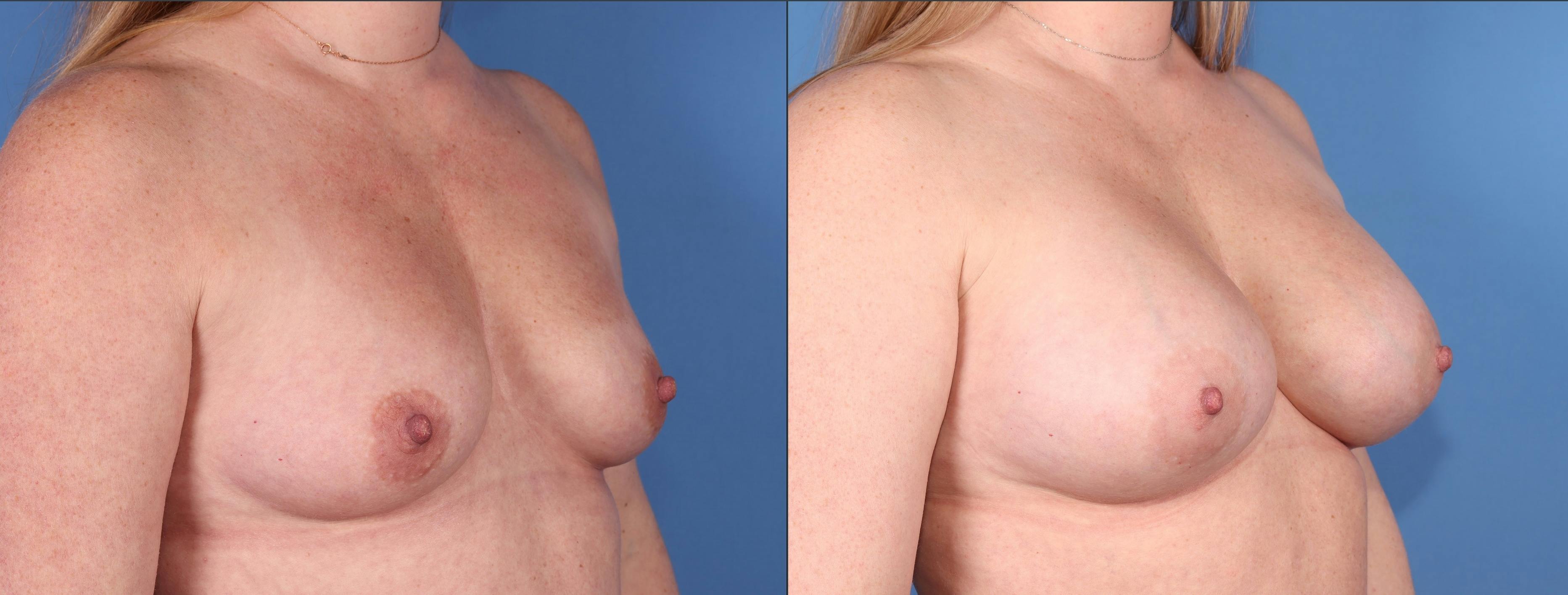 Breast Augmentation Before & After Gallery - Patient 252730 - Image 2