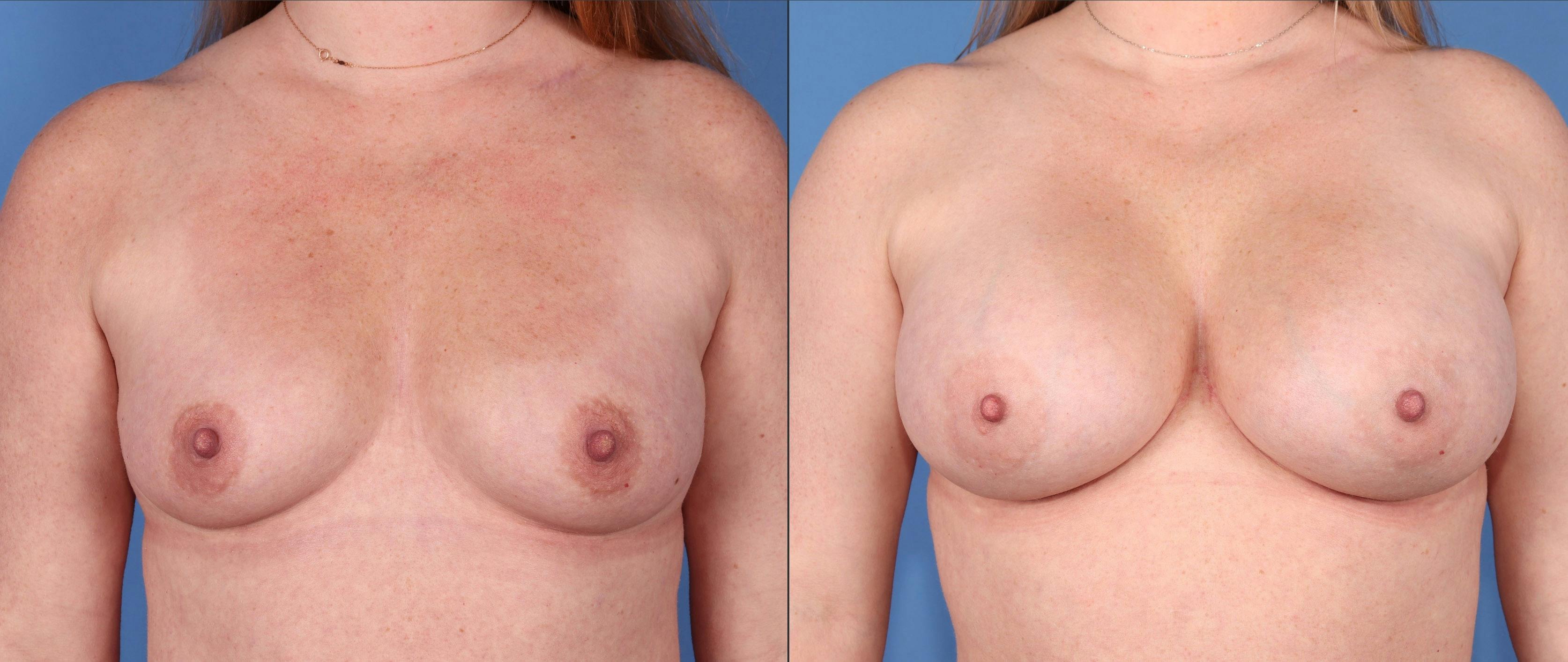 Breast Augmentation Before & After Gallery - Patient 252730 - Image 1