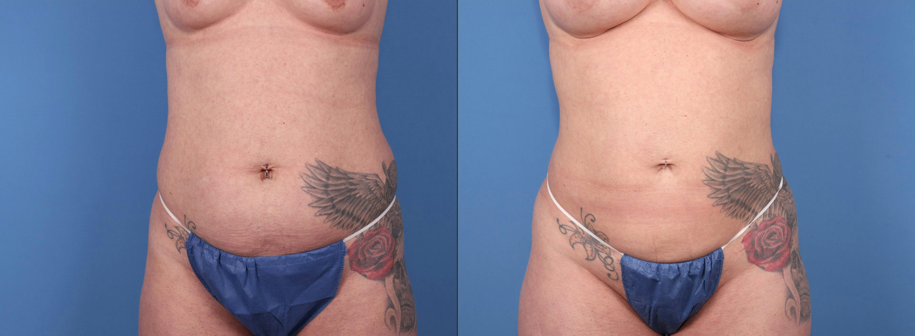 Abdomen Before & After Gallery - Patient 181114 - Image 1