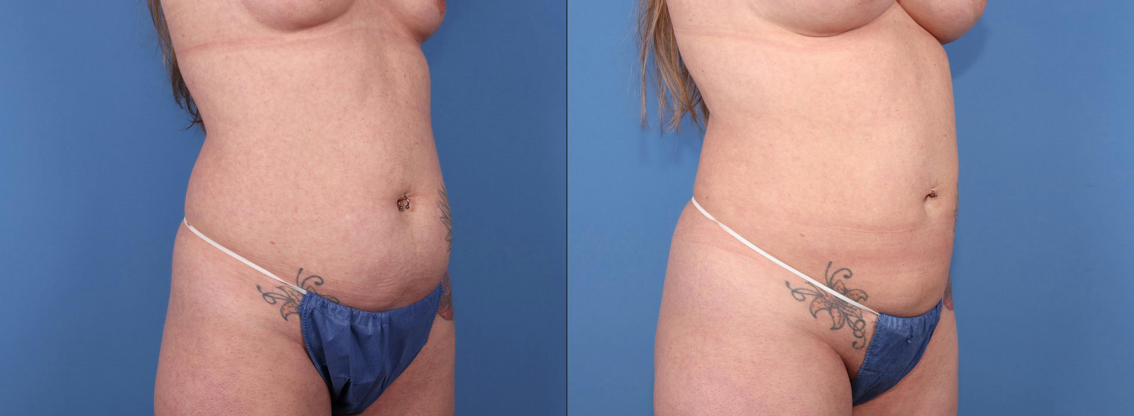 Abdomen Before & After Gallery - Patient 181114 - Image 2