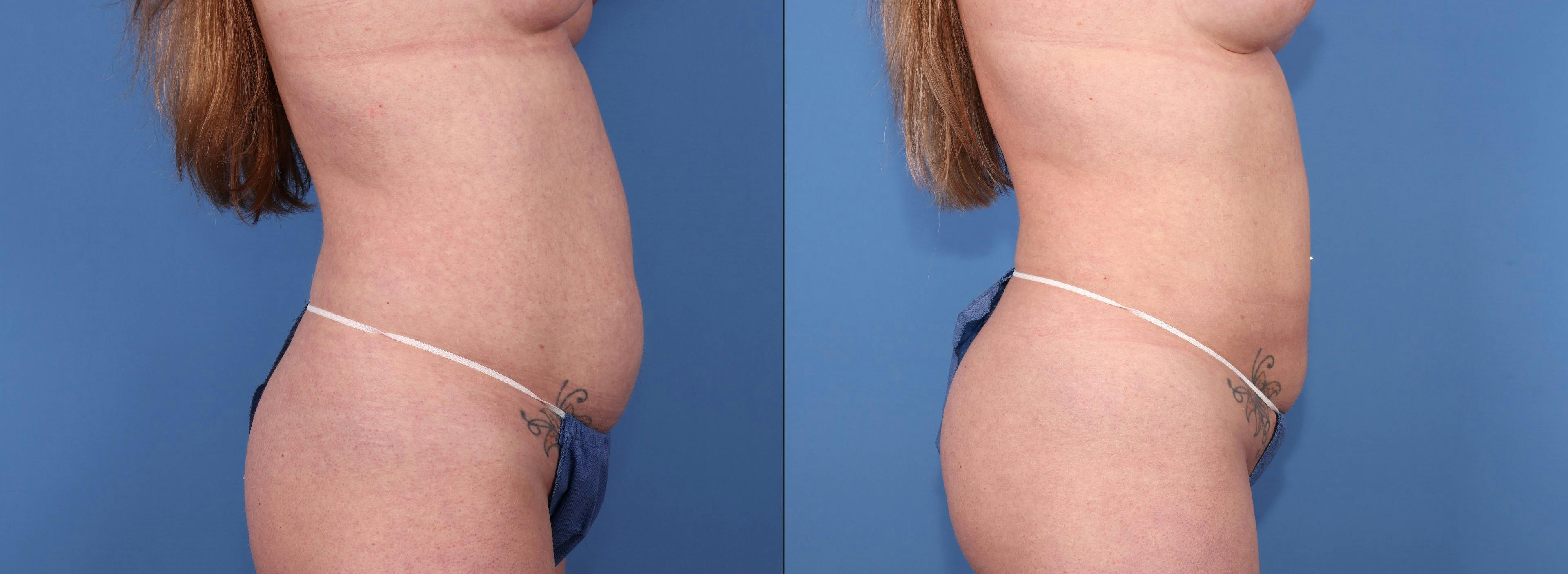 Abdomen Before & After Gallery - Patient 181114 - Image 3
