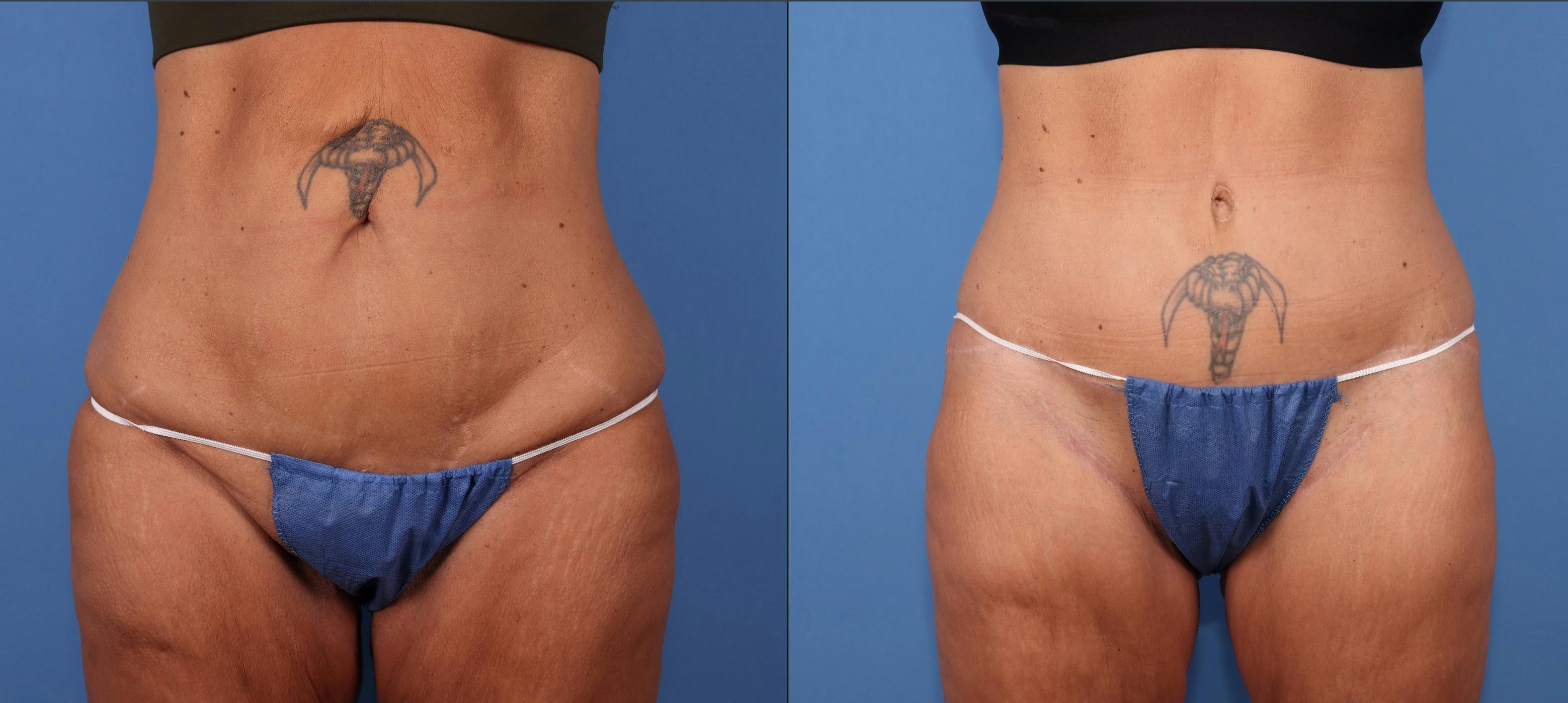 Tummy Tuck Before & After Gallery - Patient 111551 - Image 1