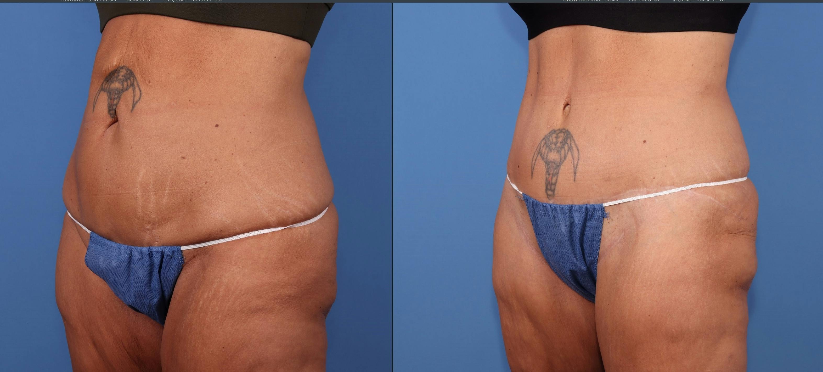 Tummy Tuck Before & After Gallery - Patient 111551 - Image 2