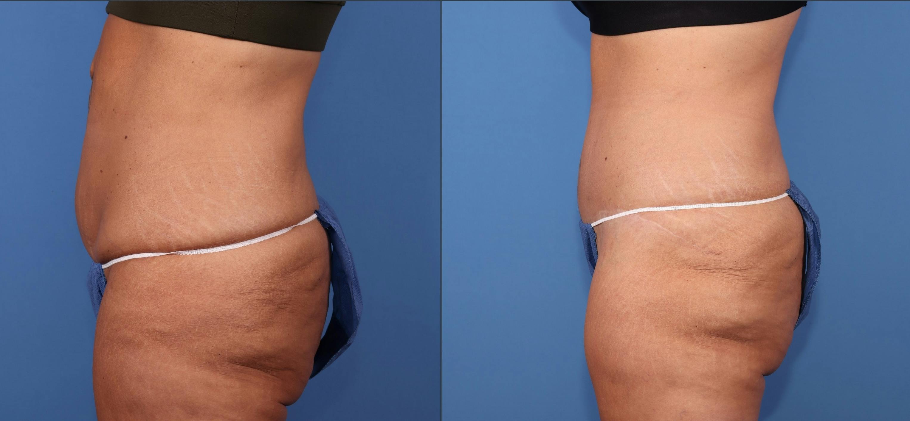 Tummy Tuck Before & After Gallery - Patient 111551 - Image 3