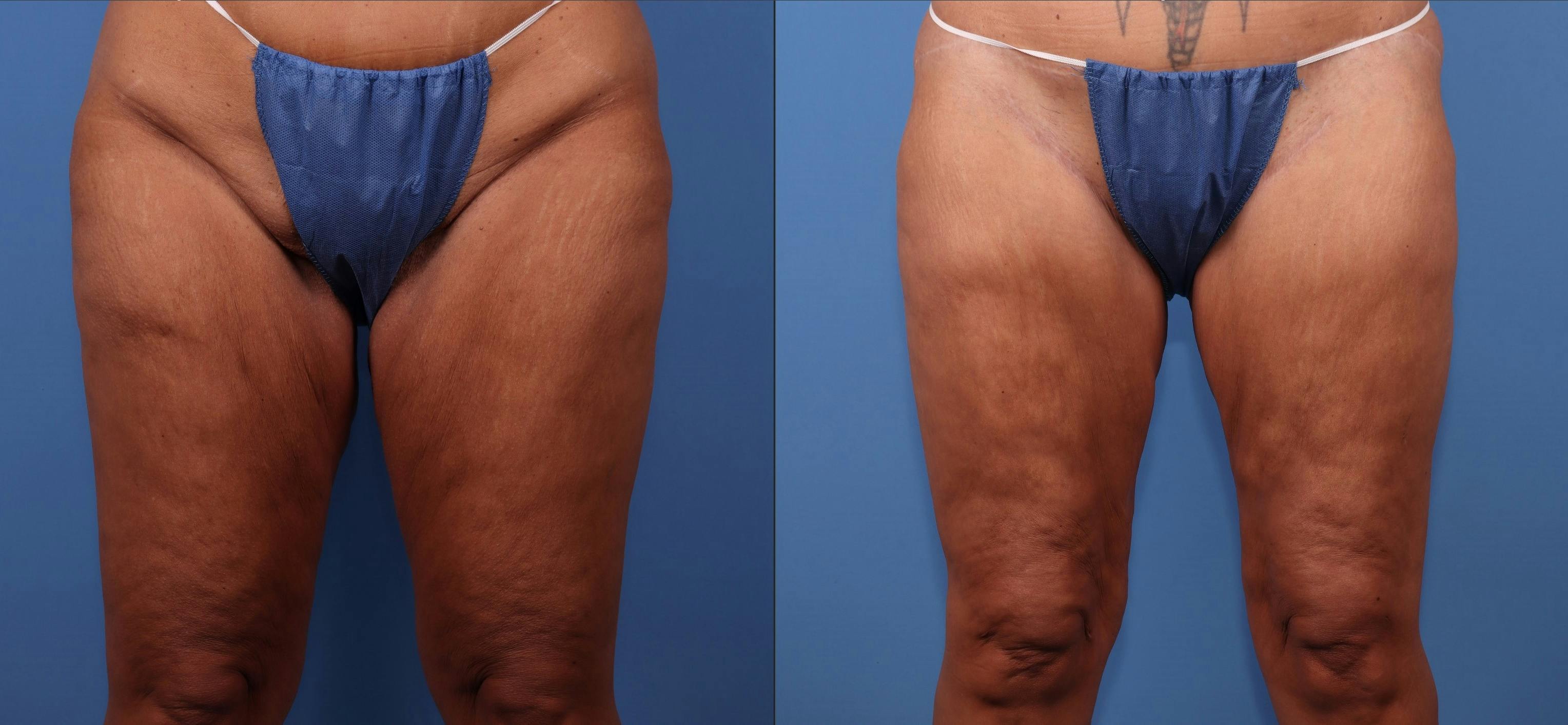 Thigh Lift Before & After Gallery - Patient 272705 - Image 1
