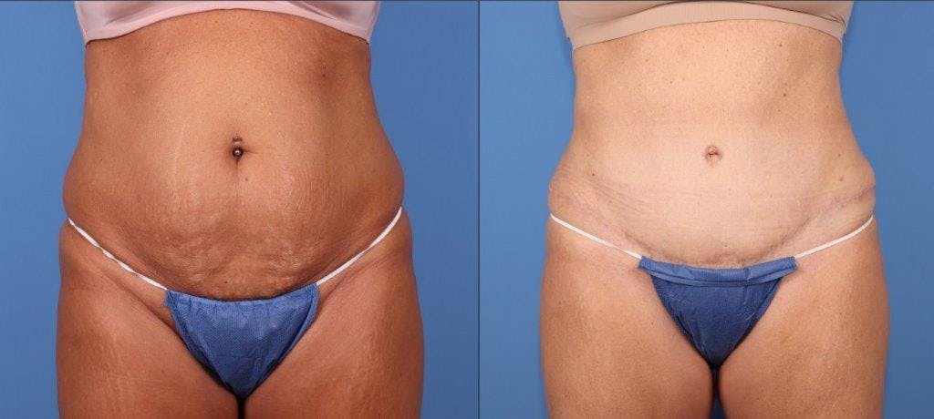 Tummy Tuck Before & After Gallery - Patient 102378 - Image 1