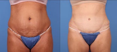 Tummy Tuck Before & After Gallery - Patient 102378 - Image 1
