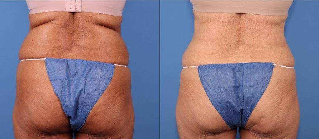 Tummy Tuck Before & After Gallery - Patient 102378 - Image 4