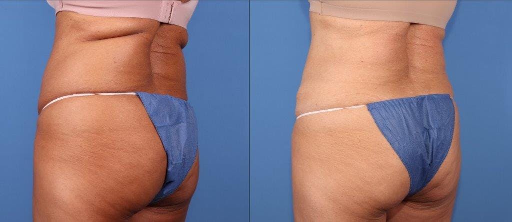 Tummy Tuck Before & After Gallery - Patient 102378 - Image 2