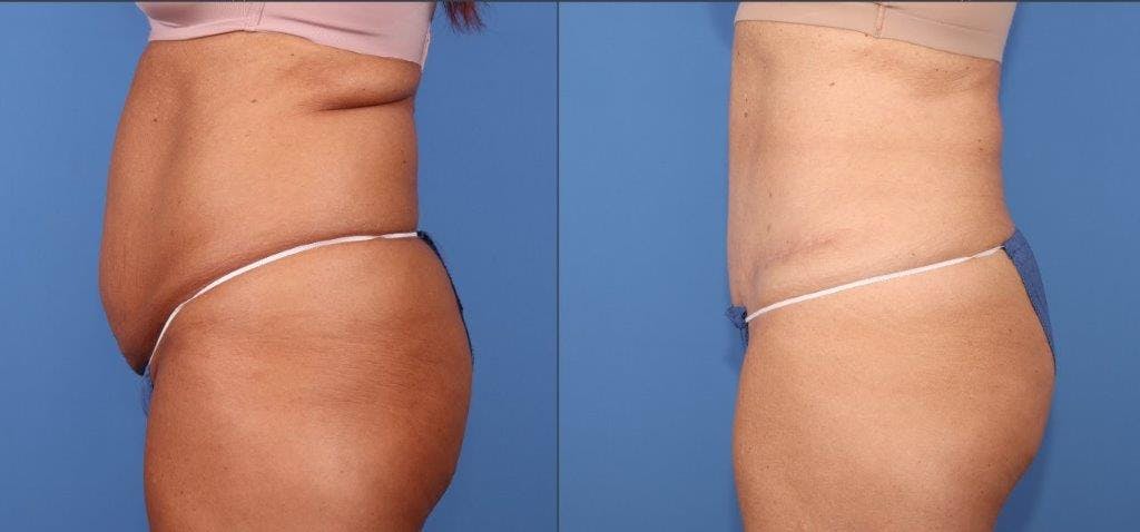 Tummy Tuck Before & After Gallery - Patient 102378 - Image 3