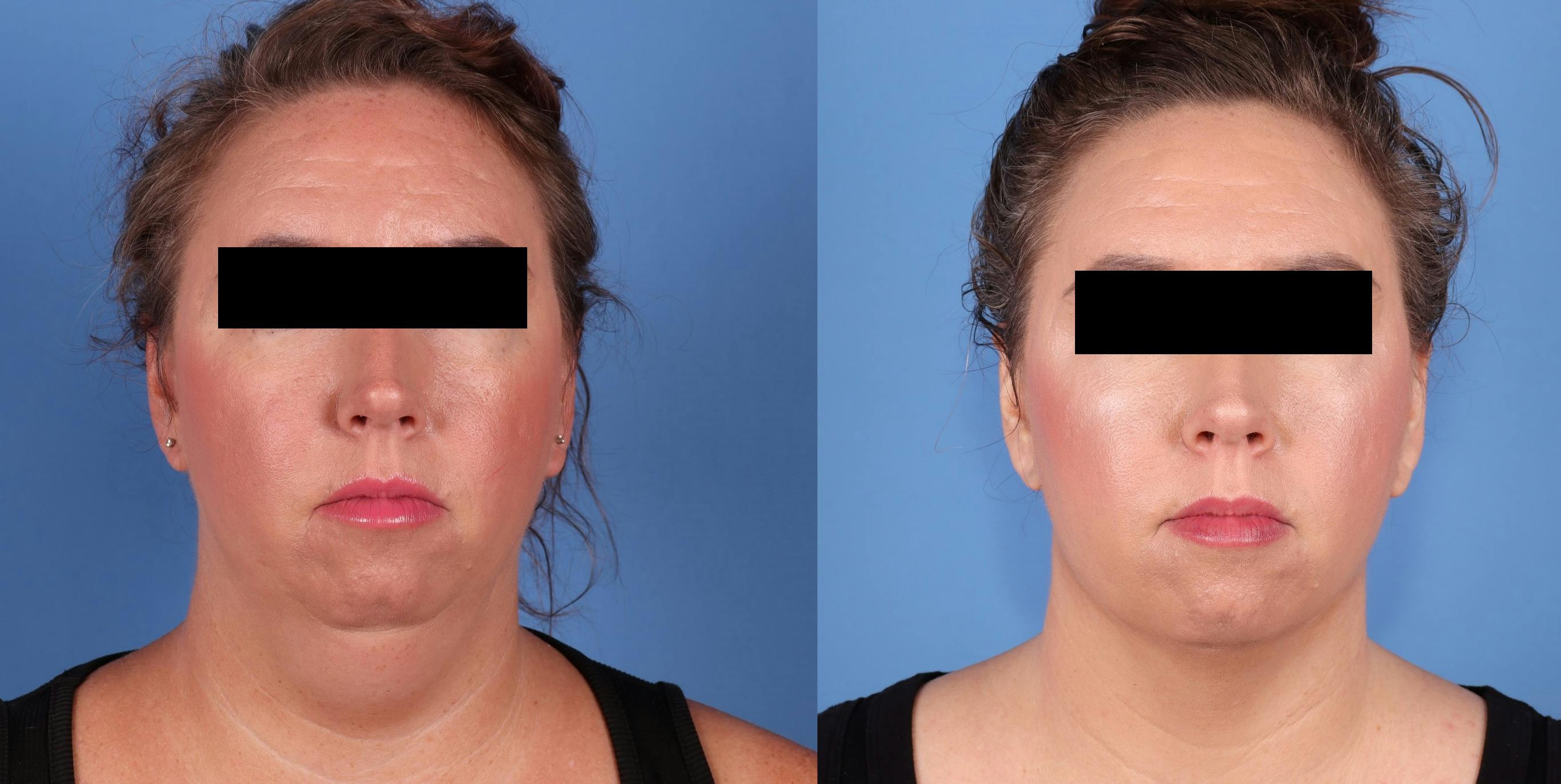 Face Before & After Gallery - Patient 681731 - Image 1