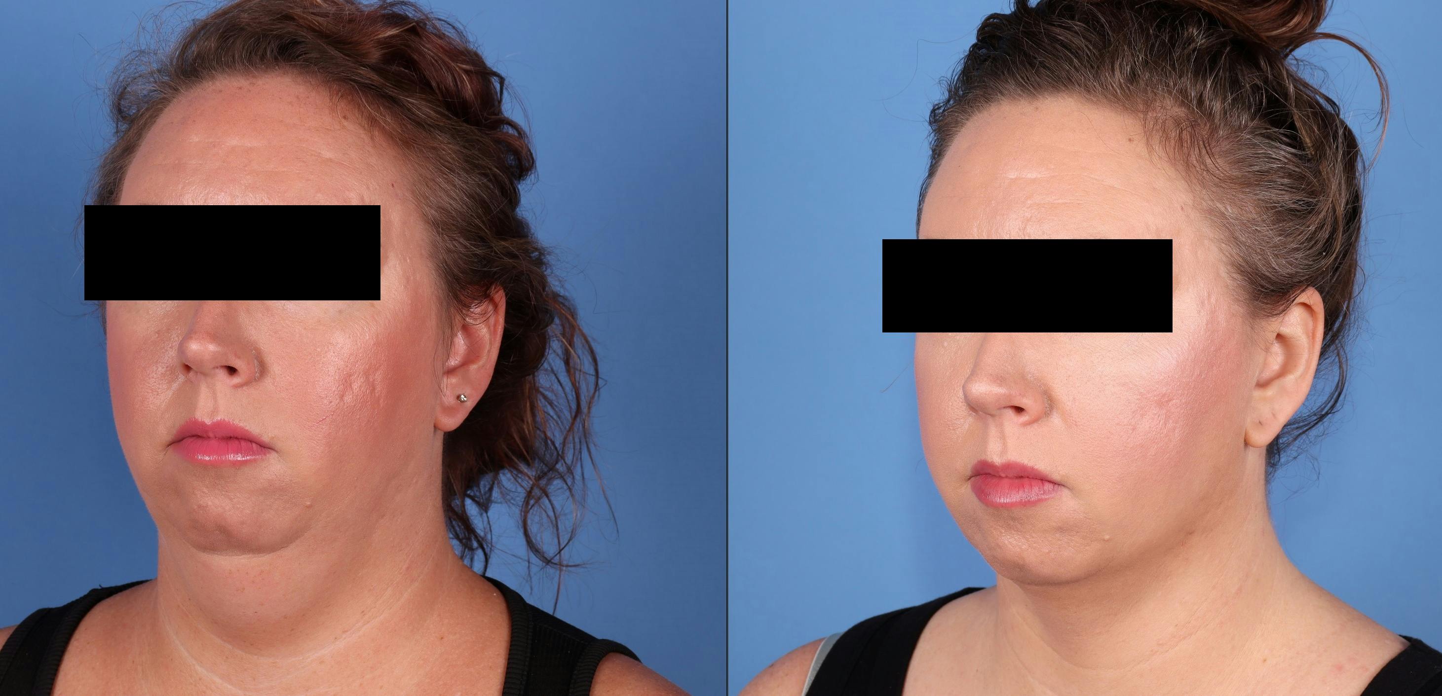 Face Before & After Gallery - Patient 681731 - Image 2