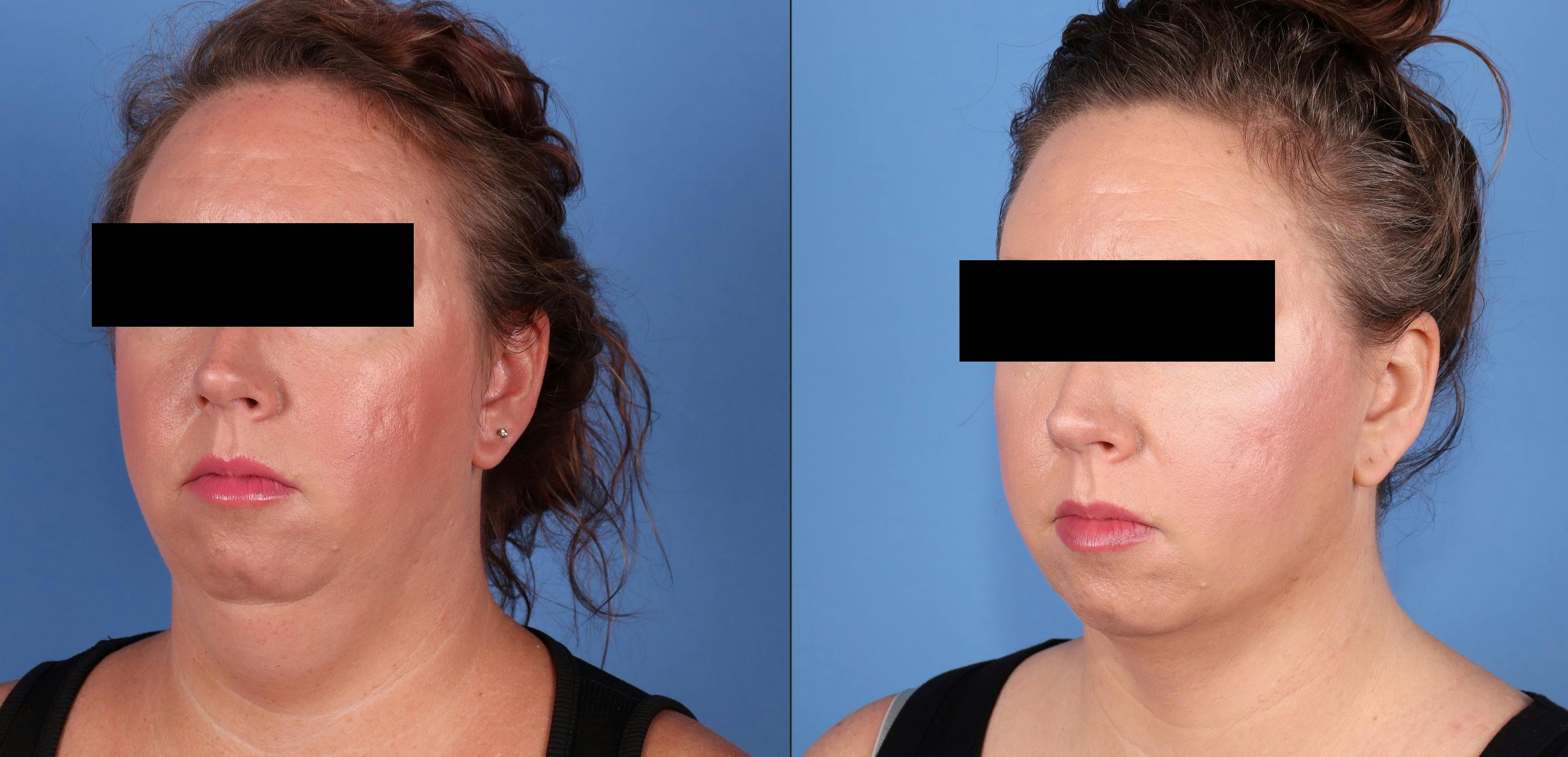 Neck Lift Before & After Gallery - Patient 604440 - Image 3