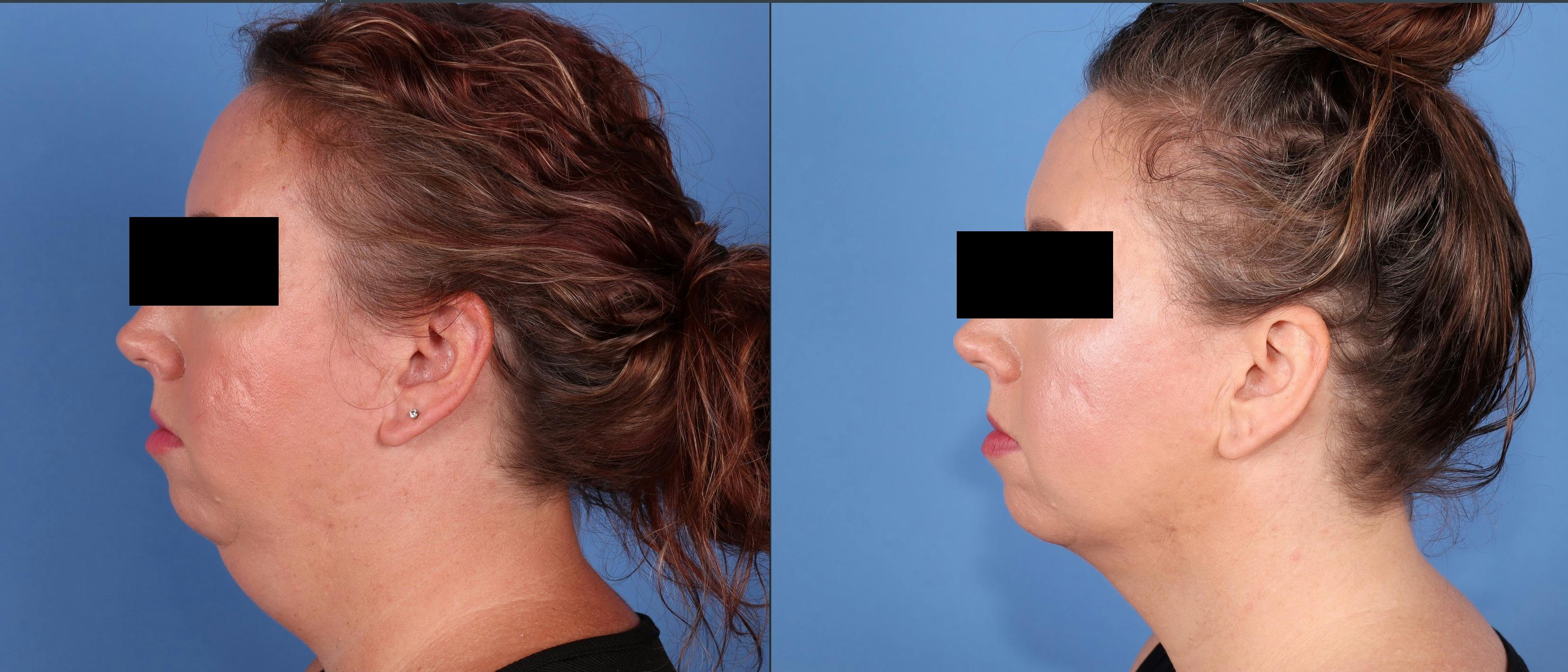 Neck Lift Before & After Gallery - Patient 604440 - Image 1