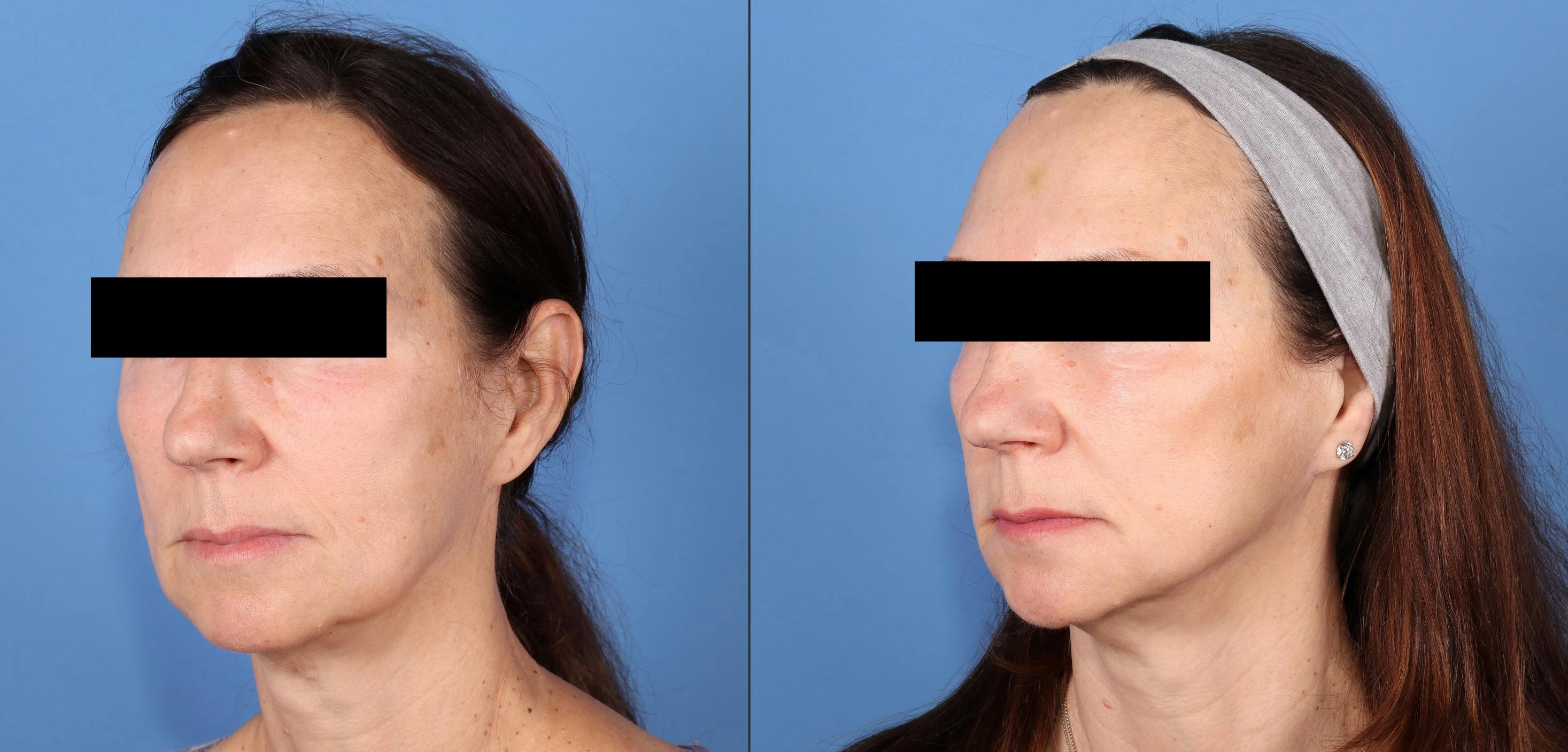 Face Before & After Gallery - Patient 208367 - Image 1