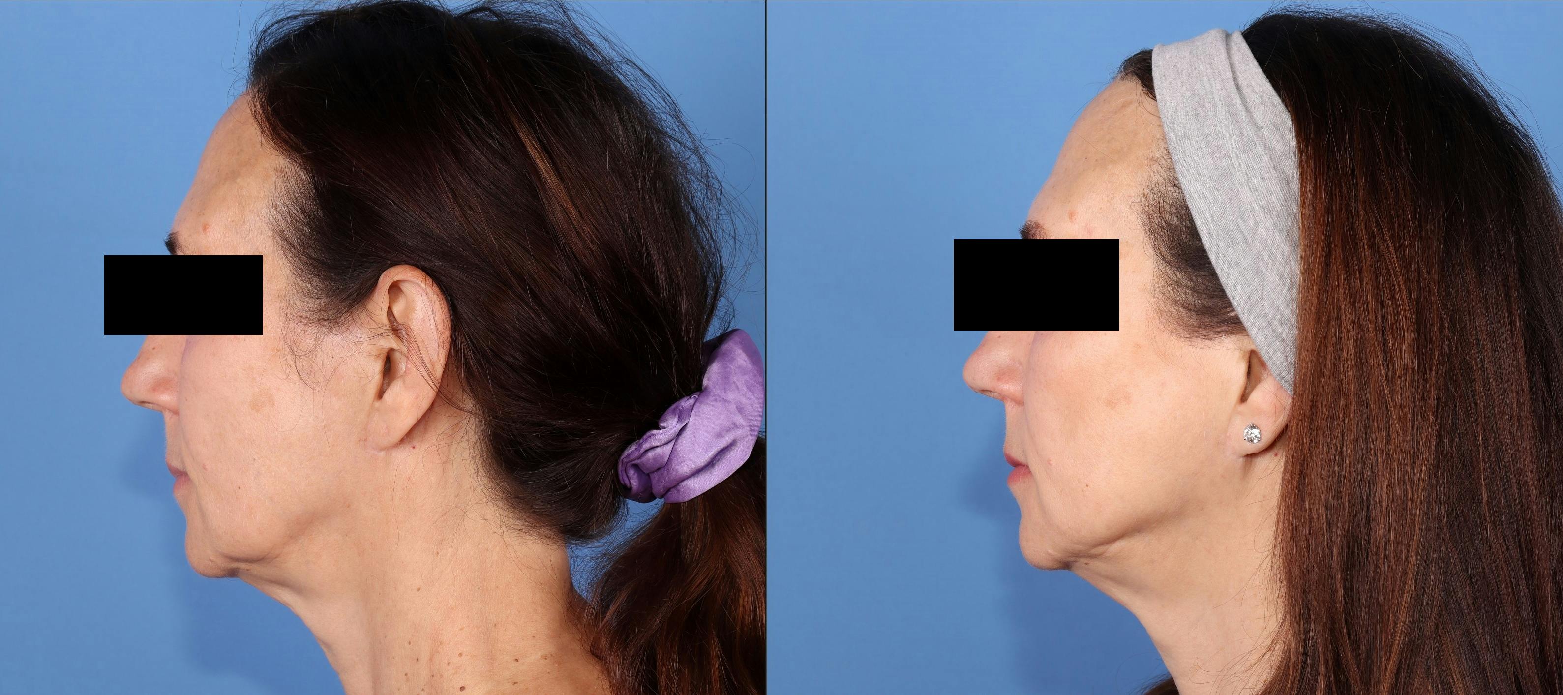 Face & Neck Before & After Gallery - Patient 208367 - Image 2