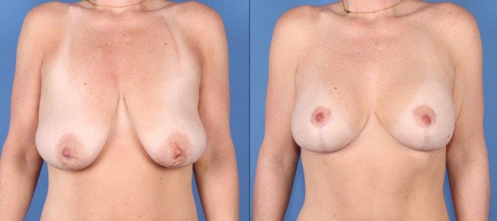 Breast Lift with Augmentation Before & After Gallery - Patient 381909 - Image 1