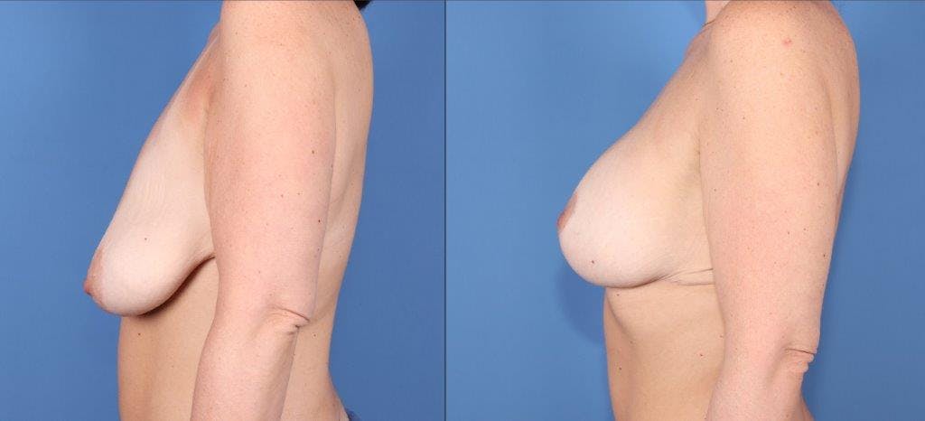 Breast Lift with Augmentation Before & After Gallery - Patient 381909 - Image 3