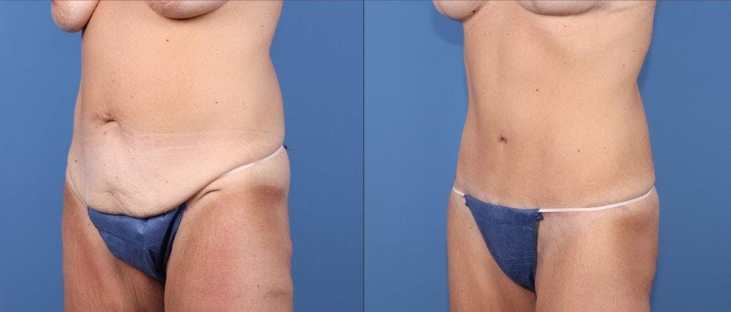 Tummy Tuck Before & After Gallery - Patient 102468 - Image 2