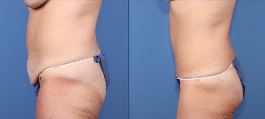 Tummy Tuck Before & After Gallery - Patient 102468 - Image 3