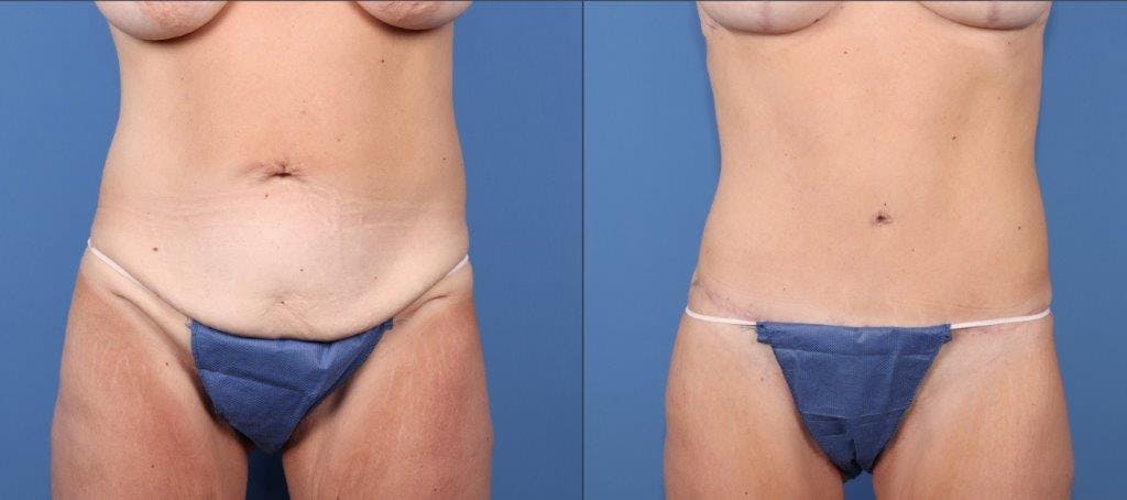 Tummy Tuck Before & After Gallery - Patient 102468 - Image 1