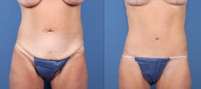 Tummy Tuck Before & After Gallery - Patient 102468 - Image 1