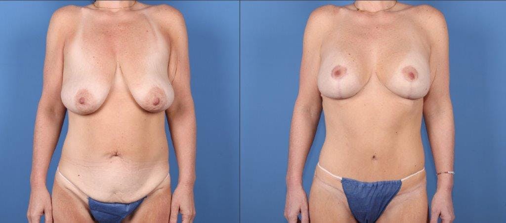 Mommy Makeover Before & After Gallery - Patient 368751 - Image 1