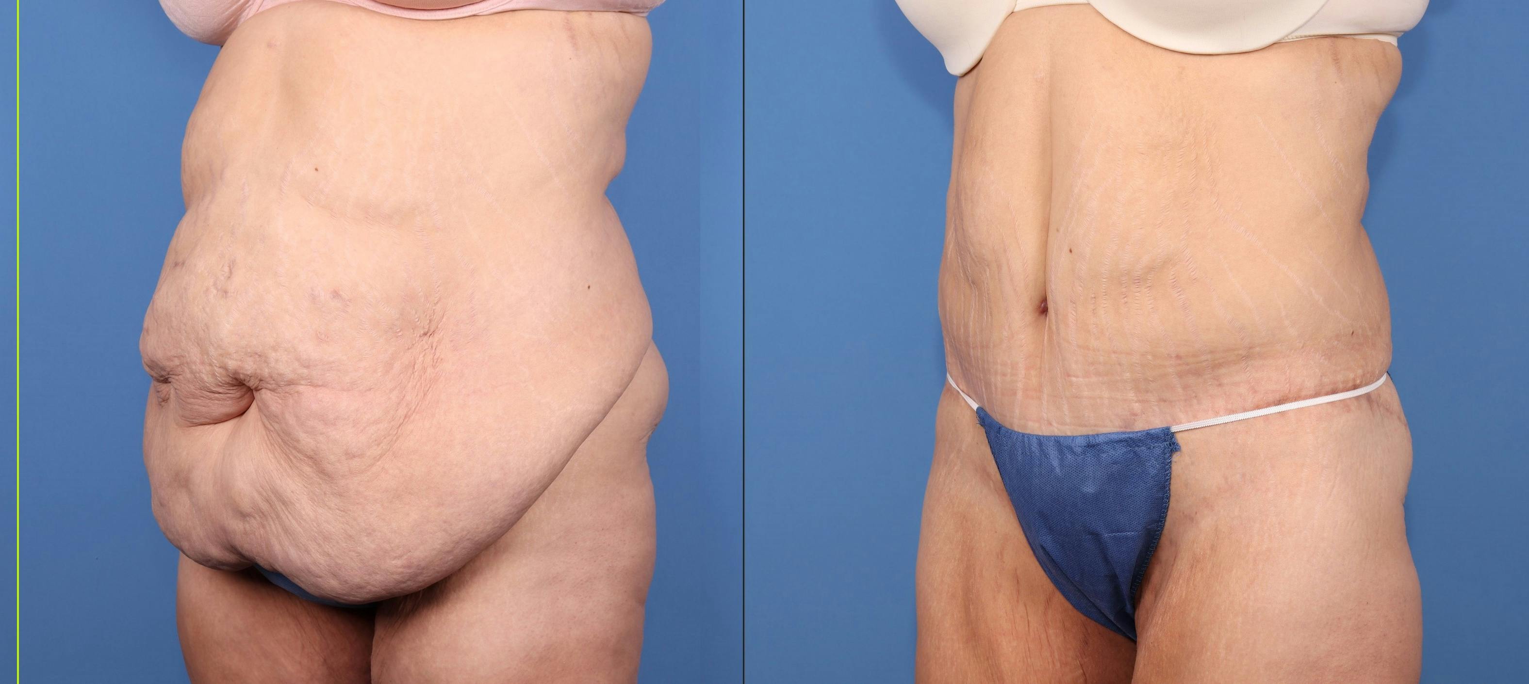 Tummy Tuck Before & After Gallery - Patient 257276 - Image 2