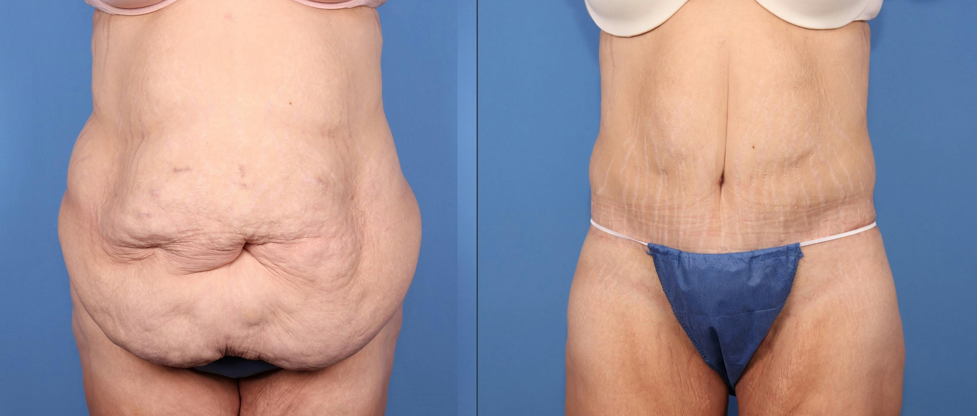 Tummy Tuck Before & After Gallery - Patient 125391 - Image 1