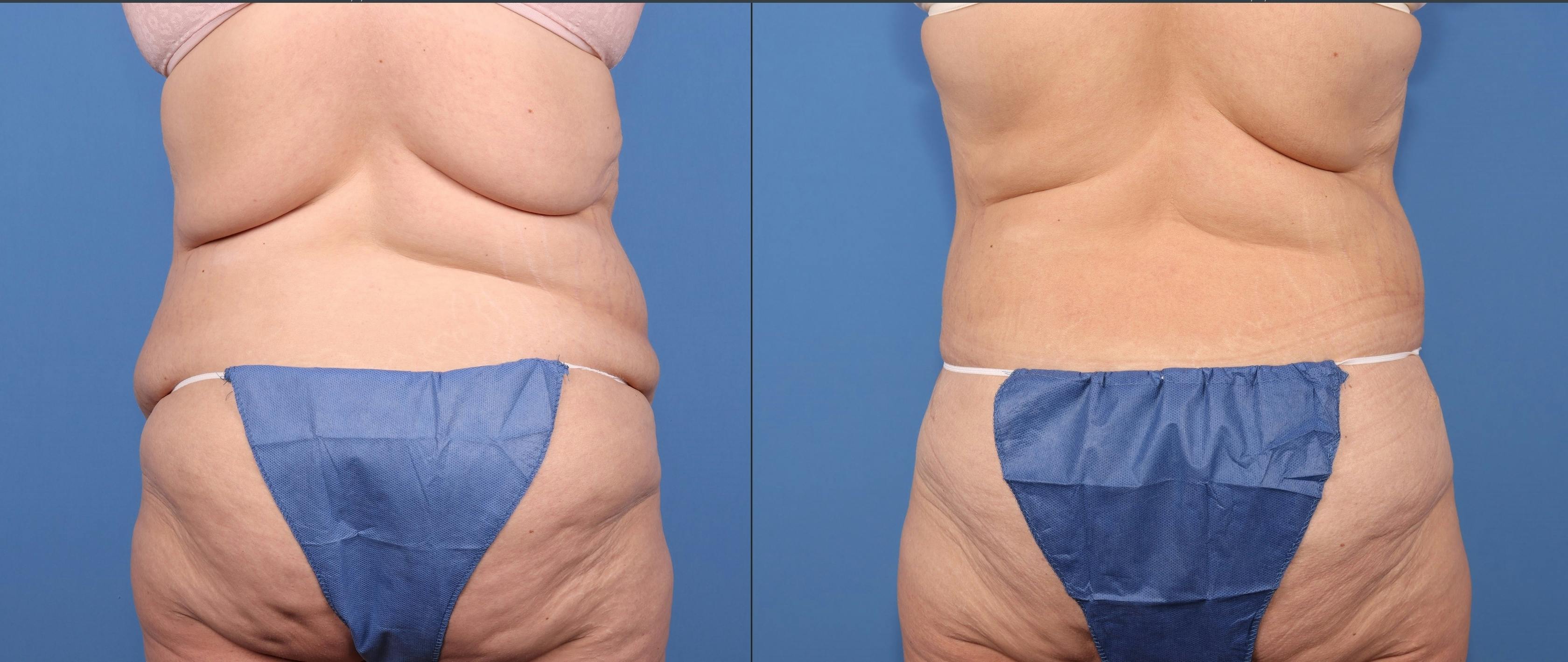 Tummy Tuck Before & After Gallery - Patient 125391 - Image 5
