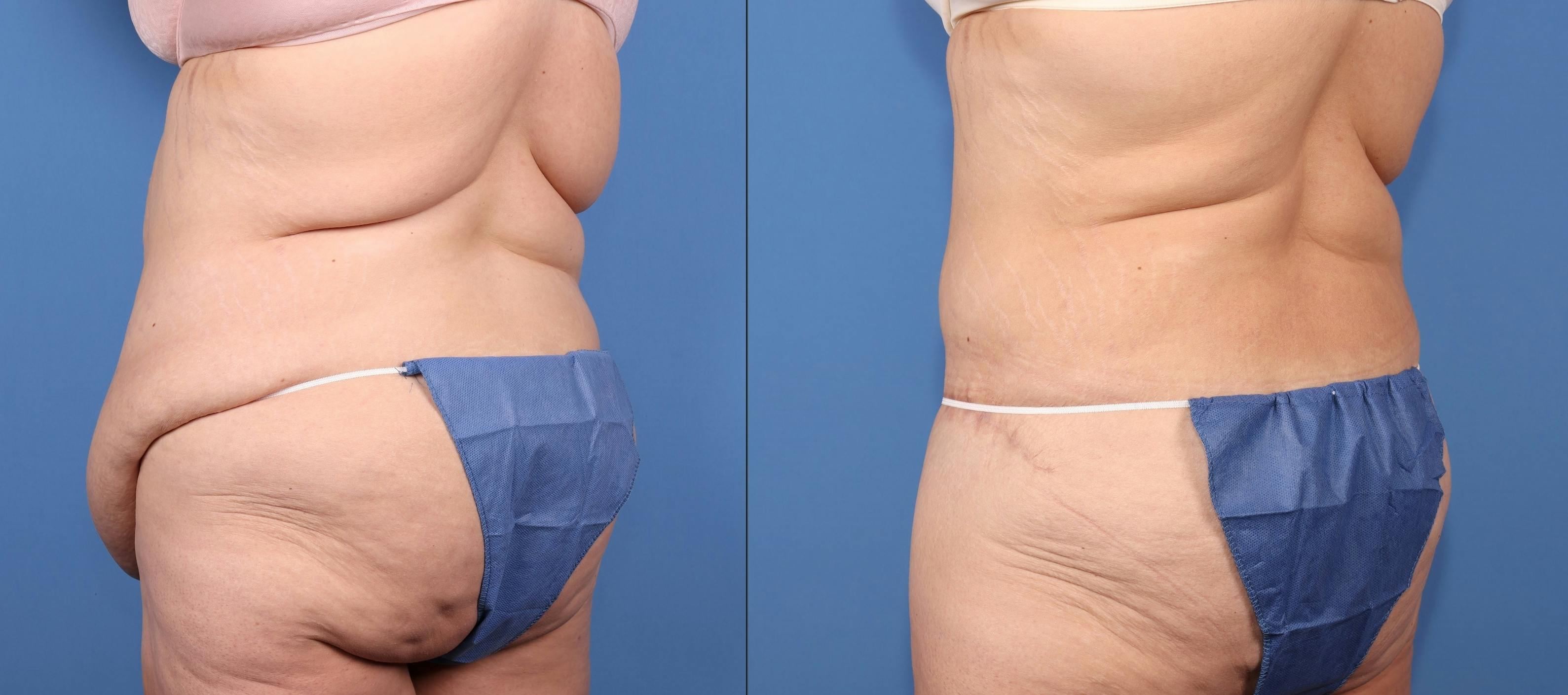 Tummy Tuck Before & After Gallery - Patient 125391 - Image 4