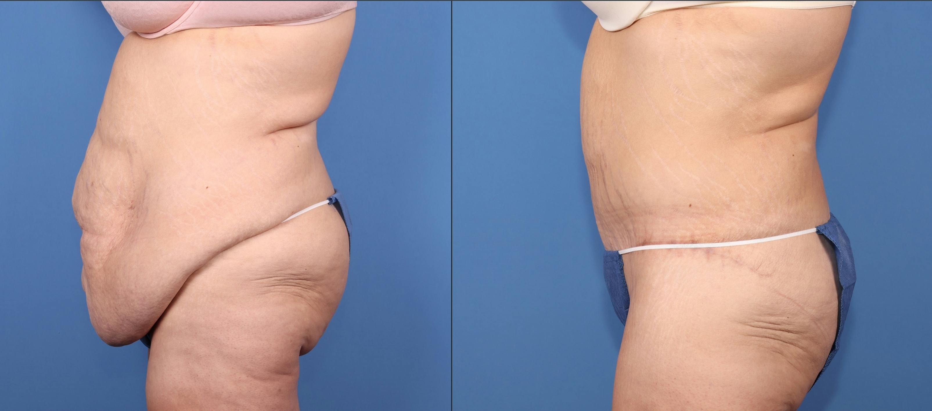 Tummy Tuck Before & After Gallery - Patient 257276 - Image 3