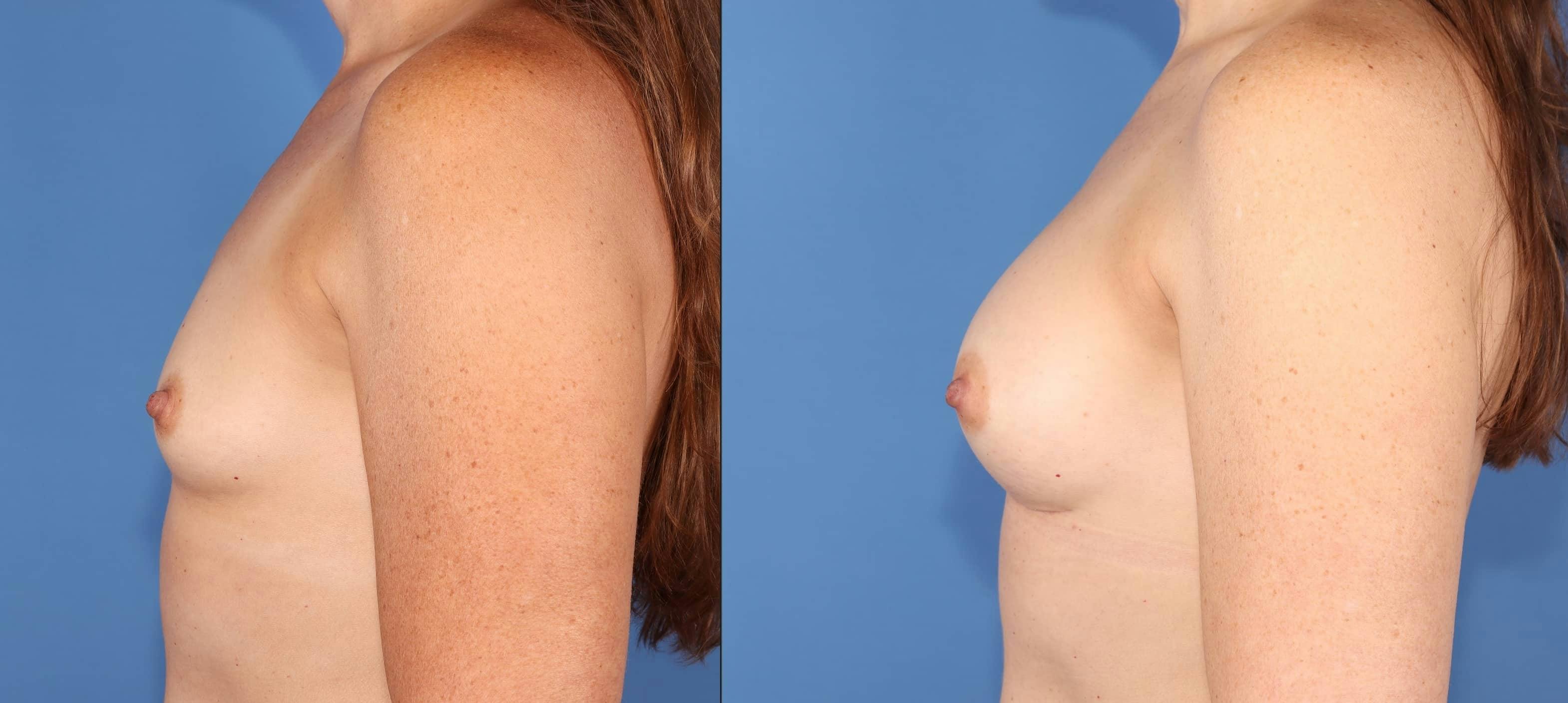 Breast Augmentation Before & After Gallery - Patient 399510 - Image 3