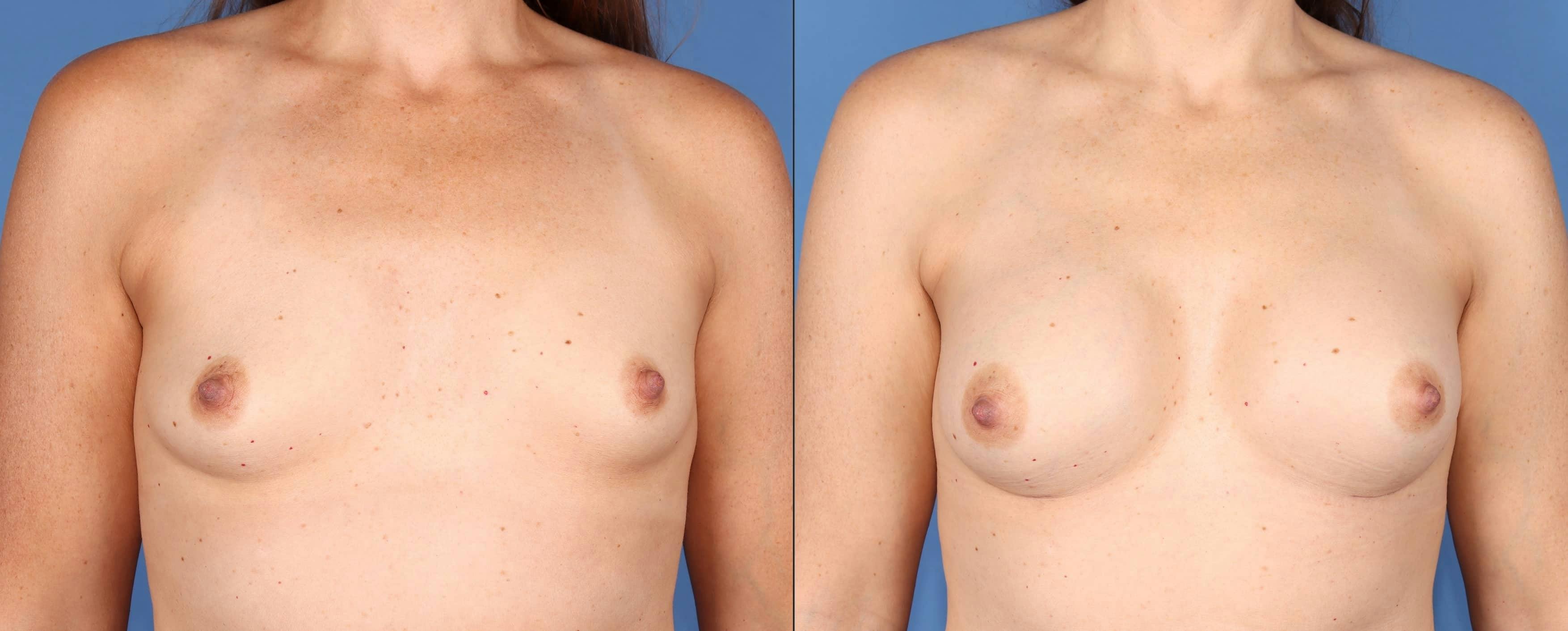 Breast Augmentation Before & After Gallery - Patient 399510 - Image 1