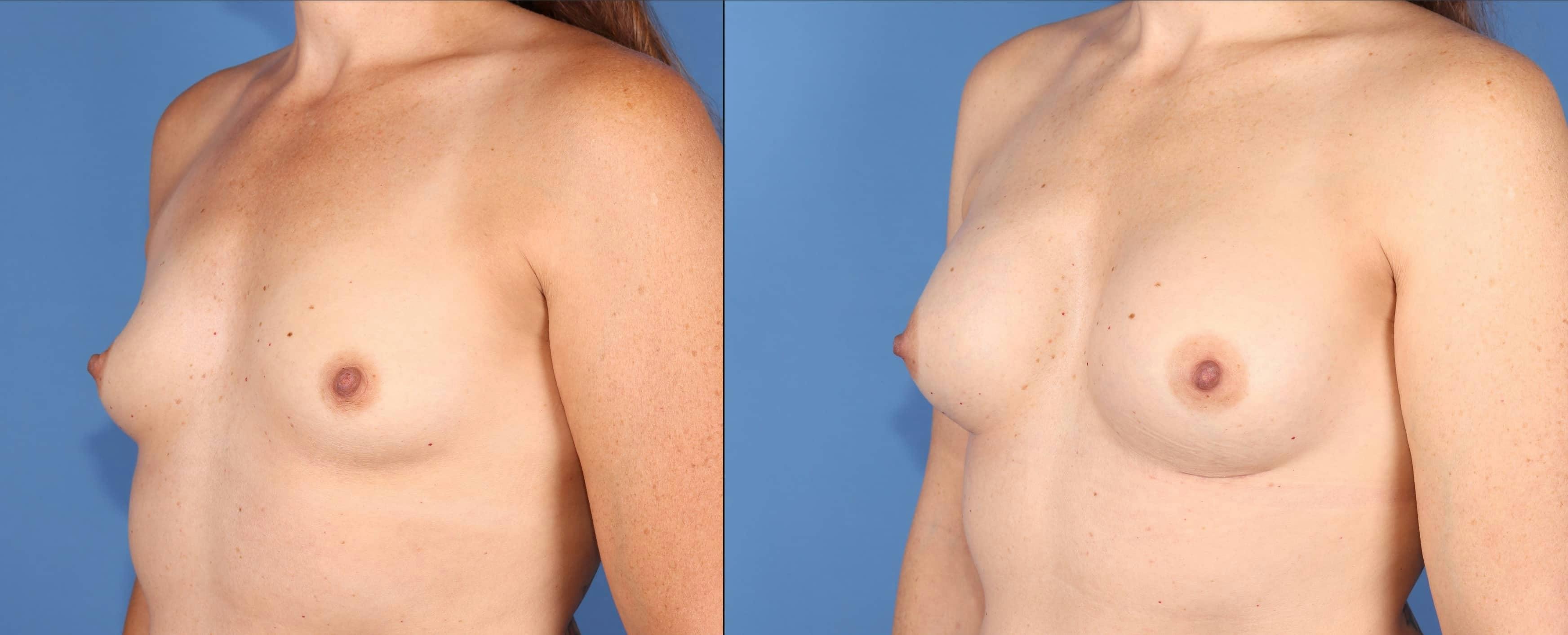 Breast Augmentation Before & After Gallery - Patient 399510 - Image 2