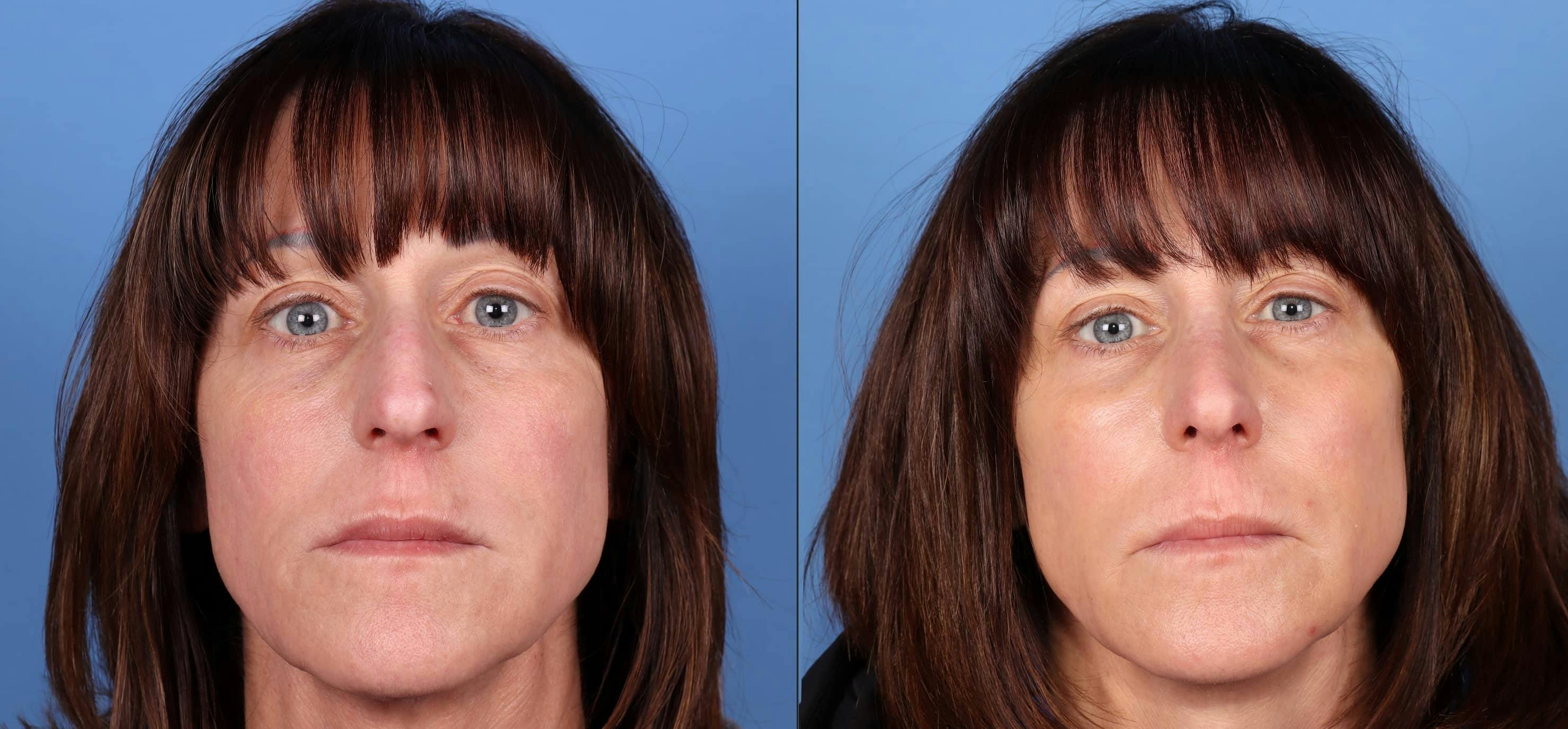 Rhinoplasty Before & After Gallery - Patient 114433 - Image 2