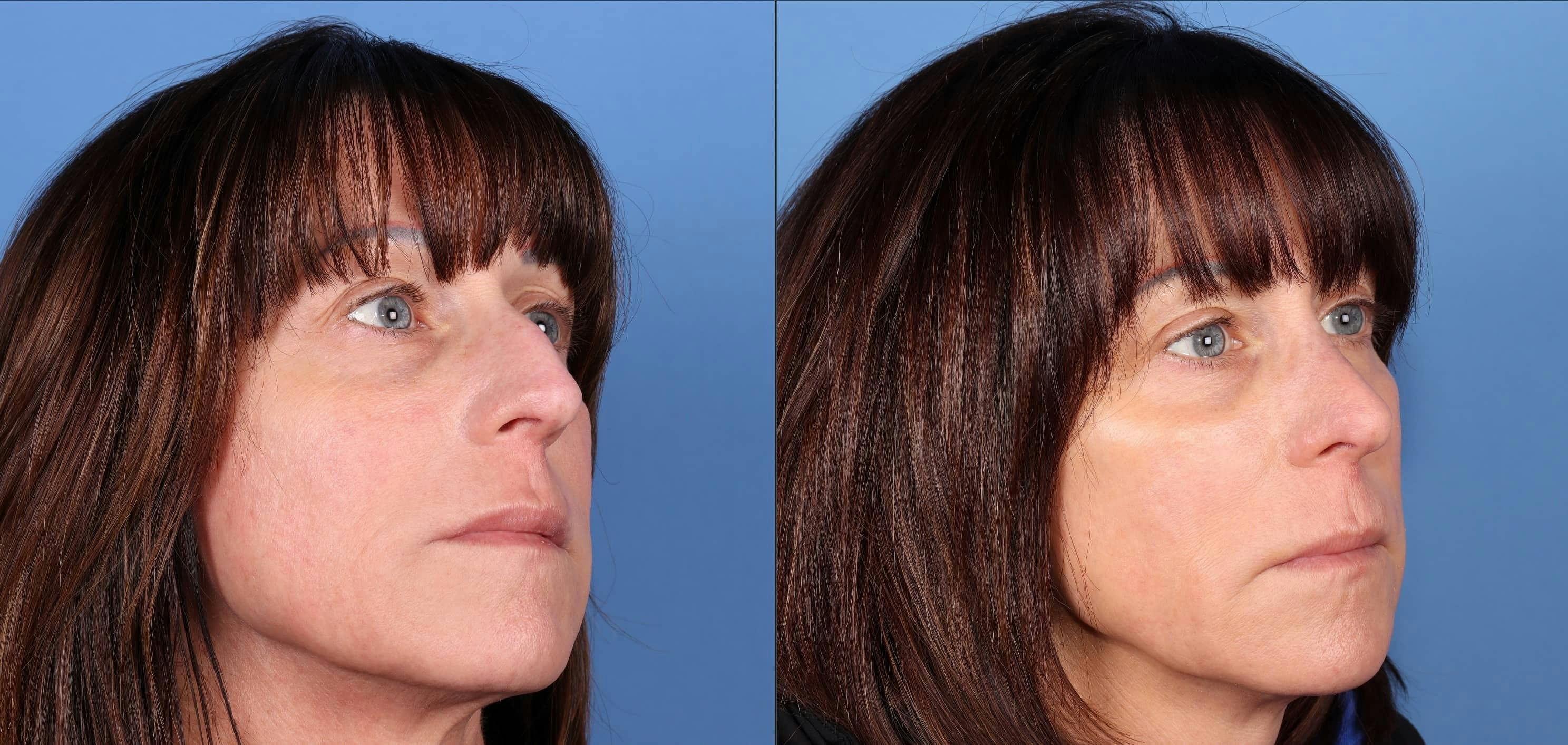 Rhinoplasty Before & After Gallery - Patient 114433 - Image 3