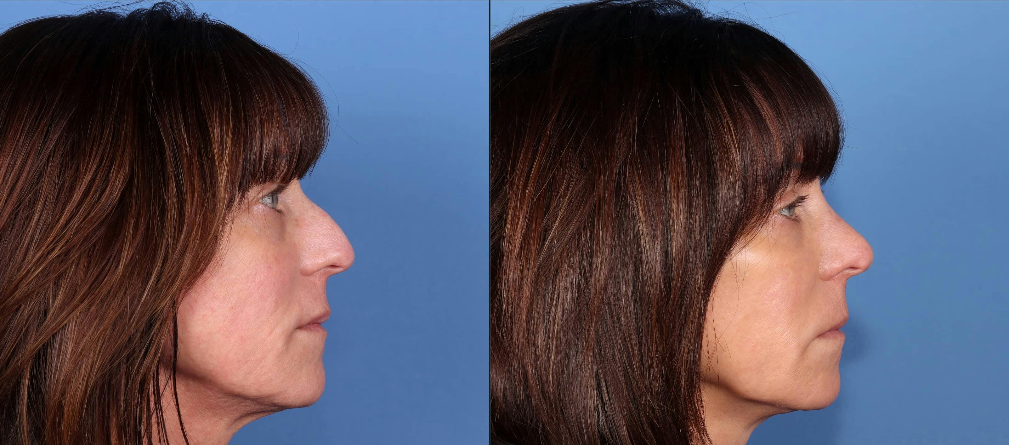 Rhinoplasty Before & After Gallery - Patient 114433 - Image 1