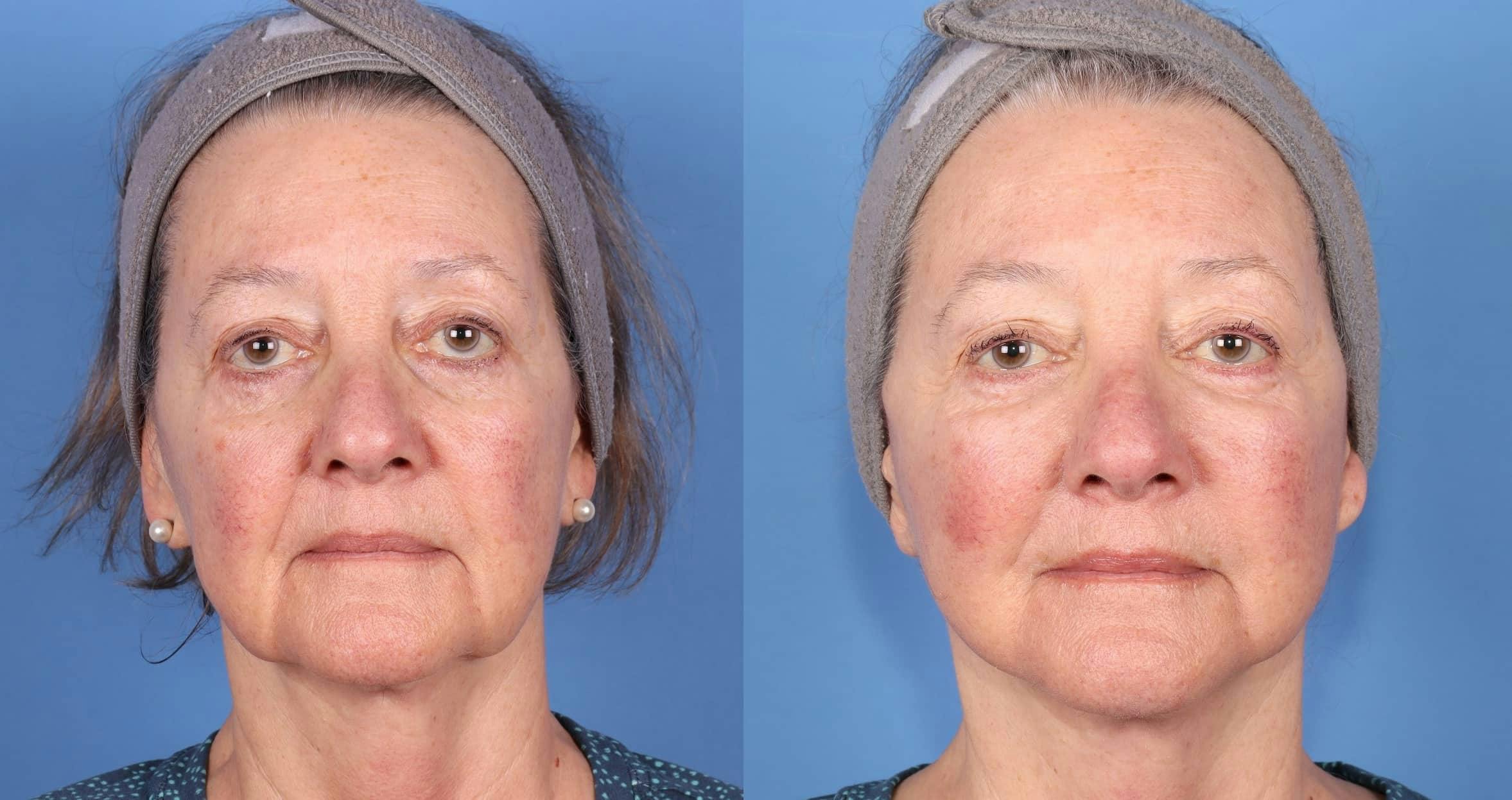Face Lift Before & After Gallery - Patient 223005 - Image 1