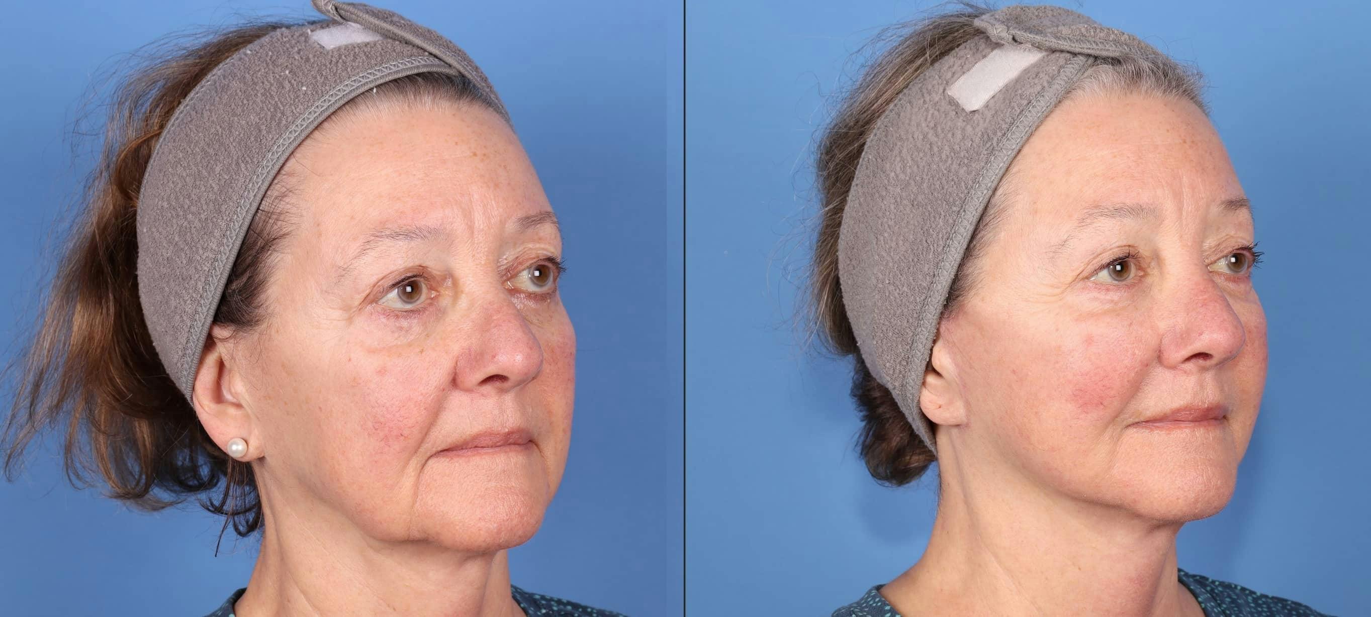 Face Lift Before & After Gallery - Patient 223005 - Image 2