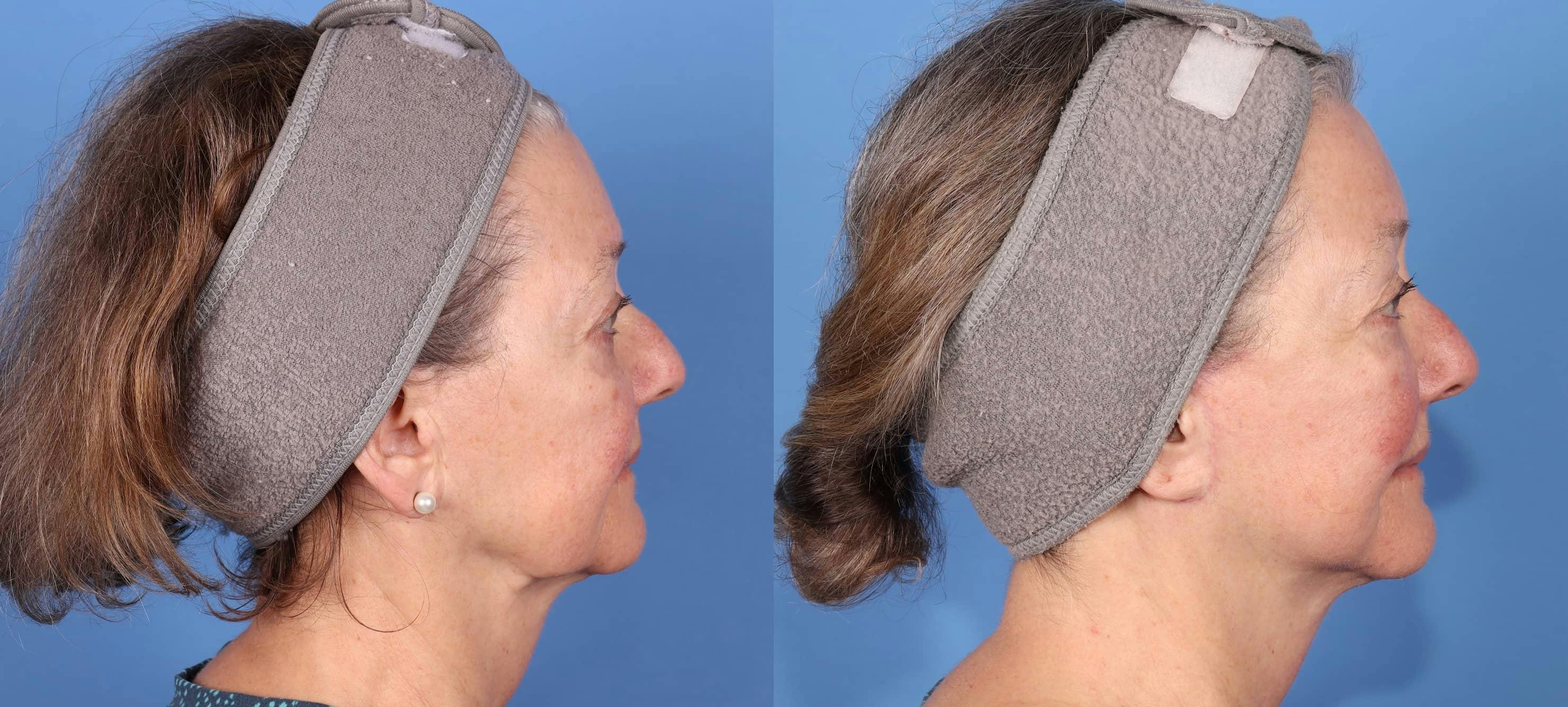 Face Lift Before & After Gallery - Patient 223005 - Image 3