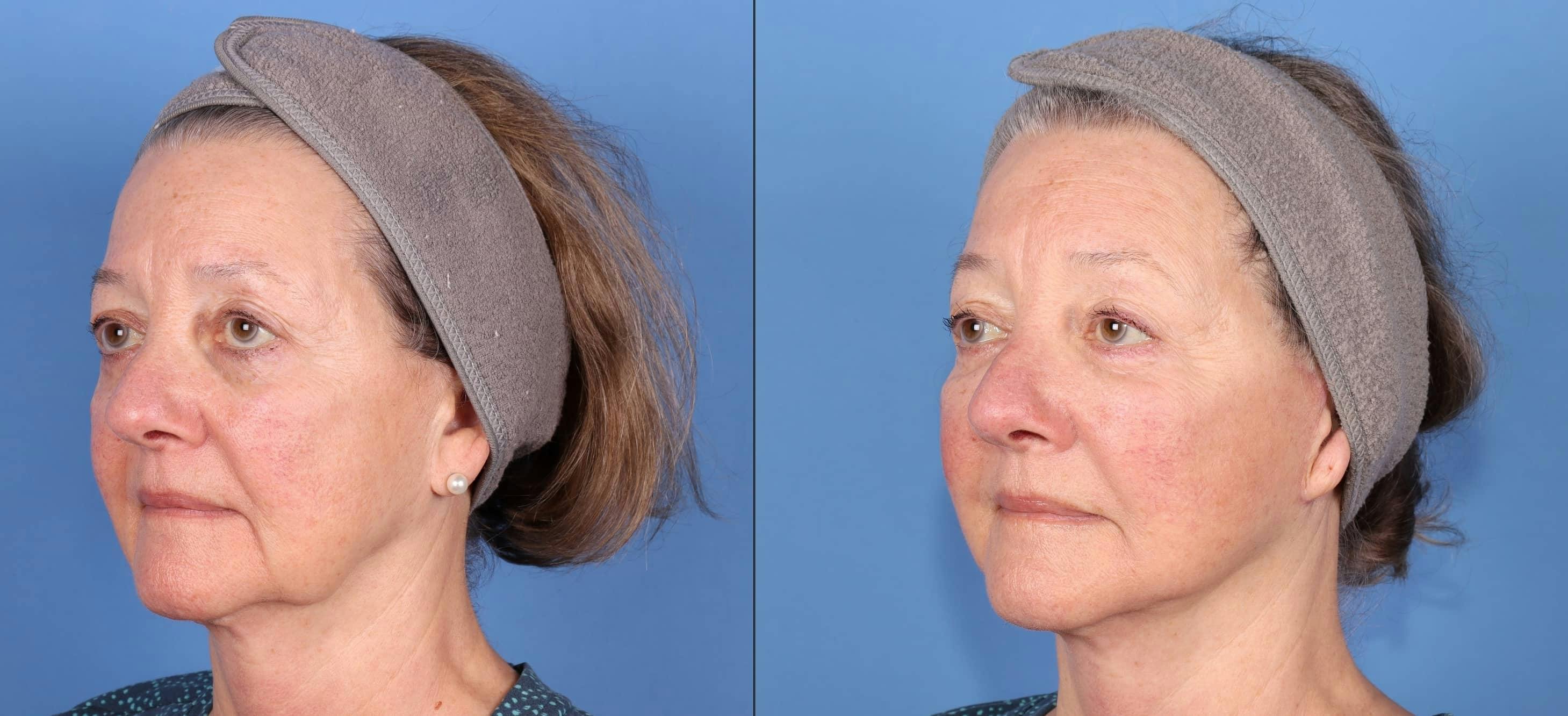 Face Lift Before & After Gallery - Patient 223005 - Image 4