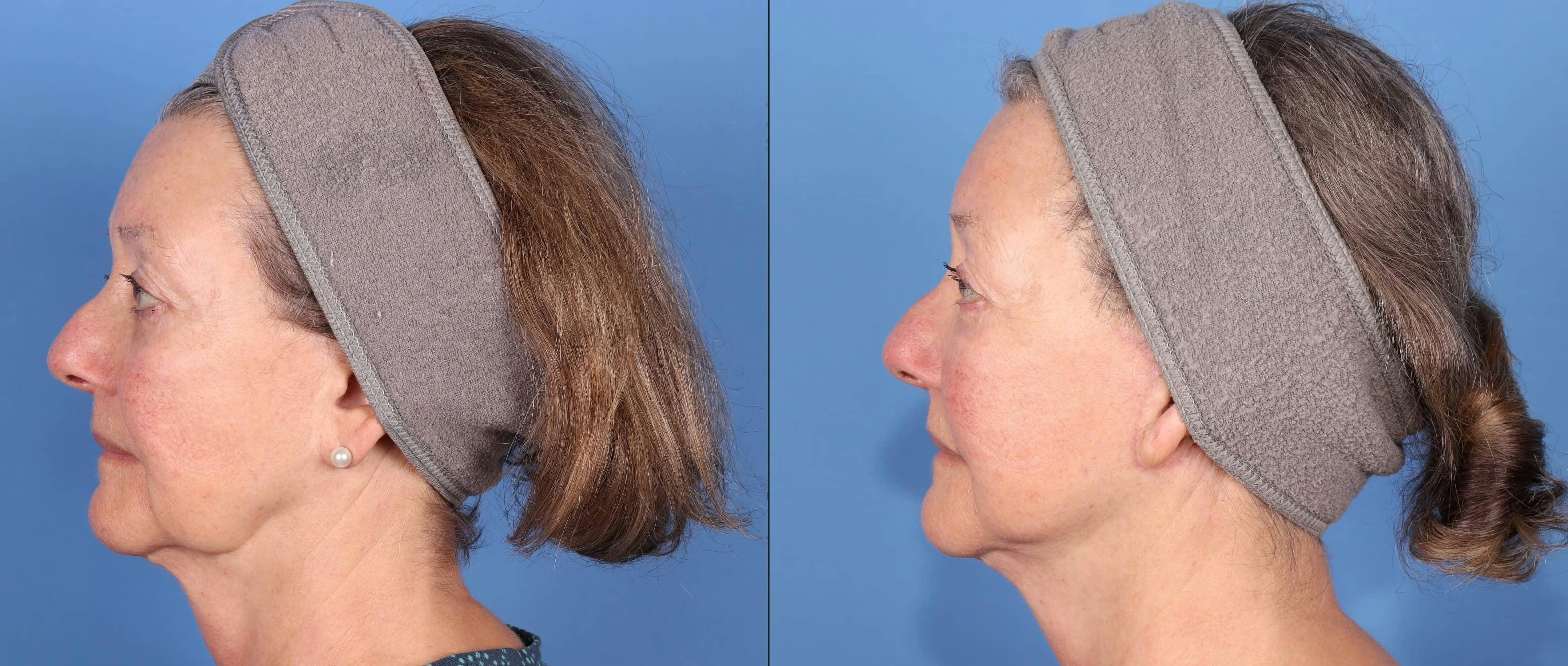Face Lift Before & After Gallery - Patient 223005 - Image 5