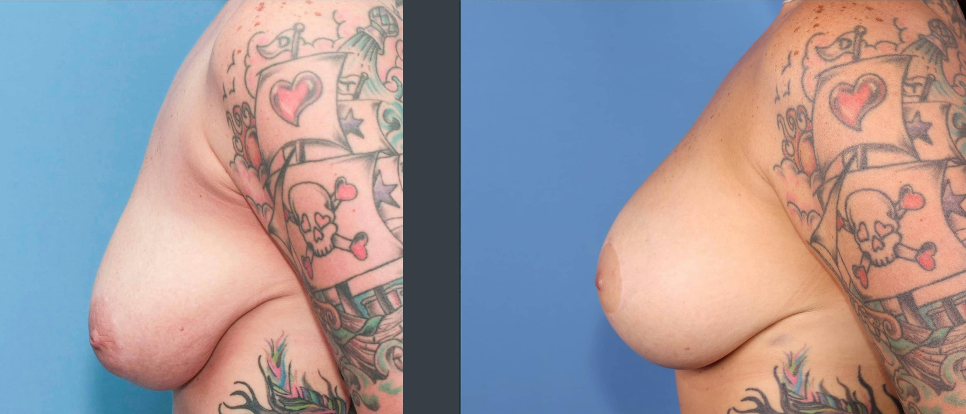 Breast Lift with Augmentation Before & After Gallery - Patient 299143 - Image 3