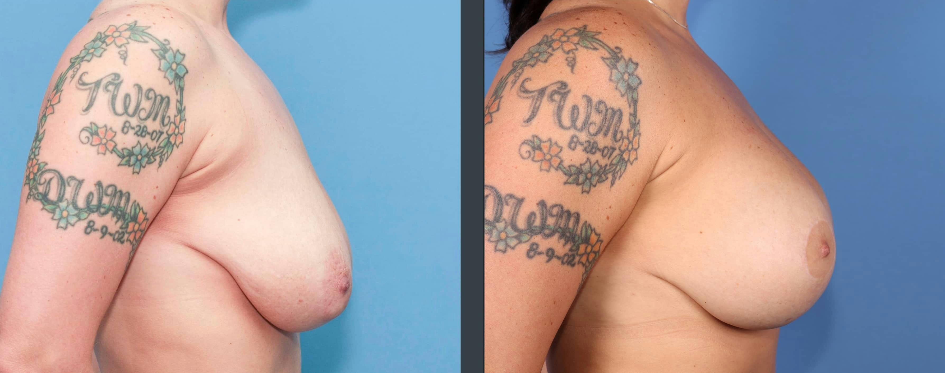 Breast Lift with Augmentation Before & After Gallery - Patient 299143 - Image 4